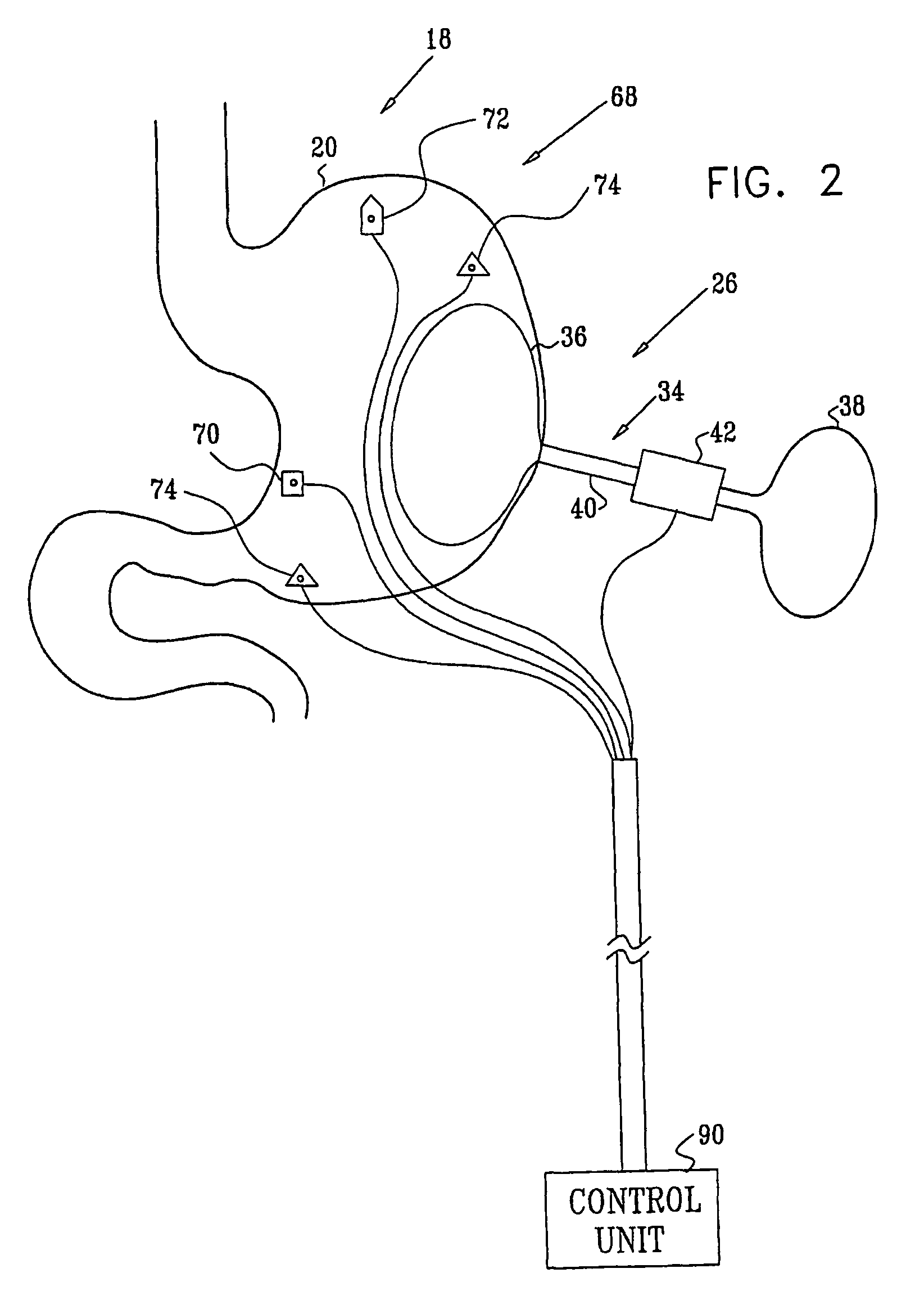 Gastrointestinal methods and apparatus for use in treating disorders and controlling blood sugar