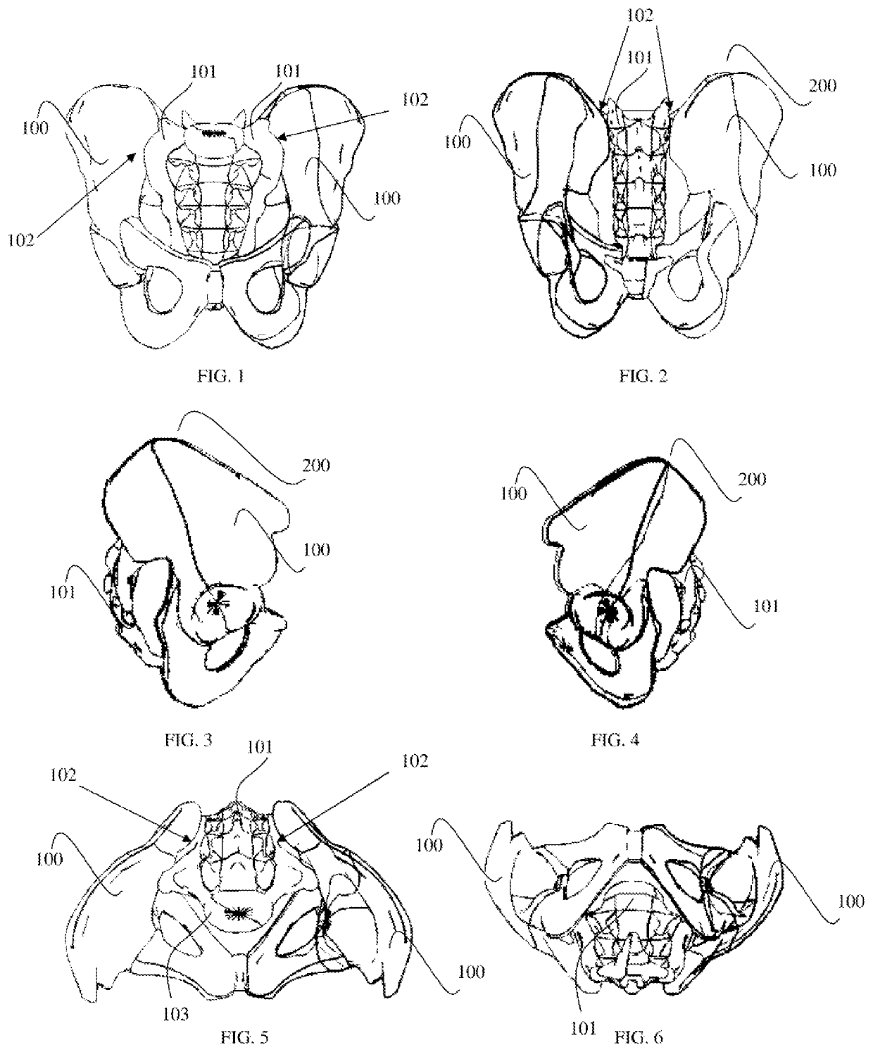 Instruments and methods for posterior surgical approach for sacroiliac joint