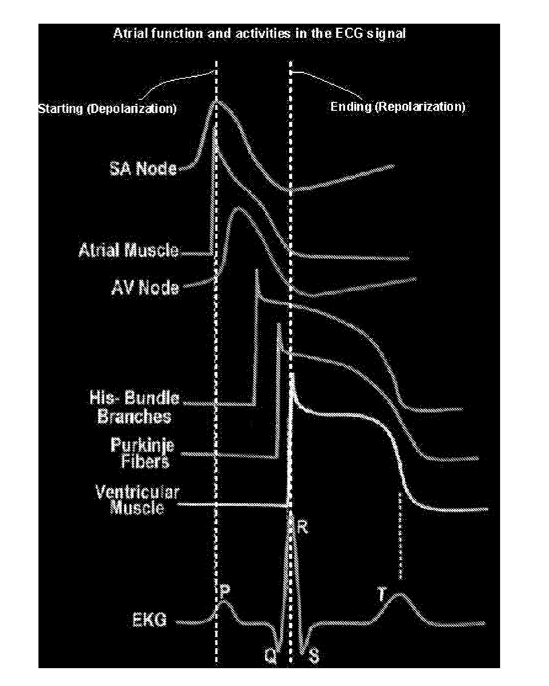 Signal Analysis System for Heart Condition Determination