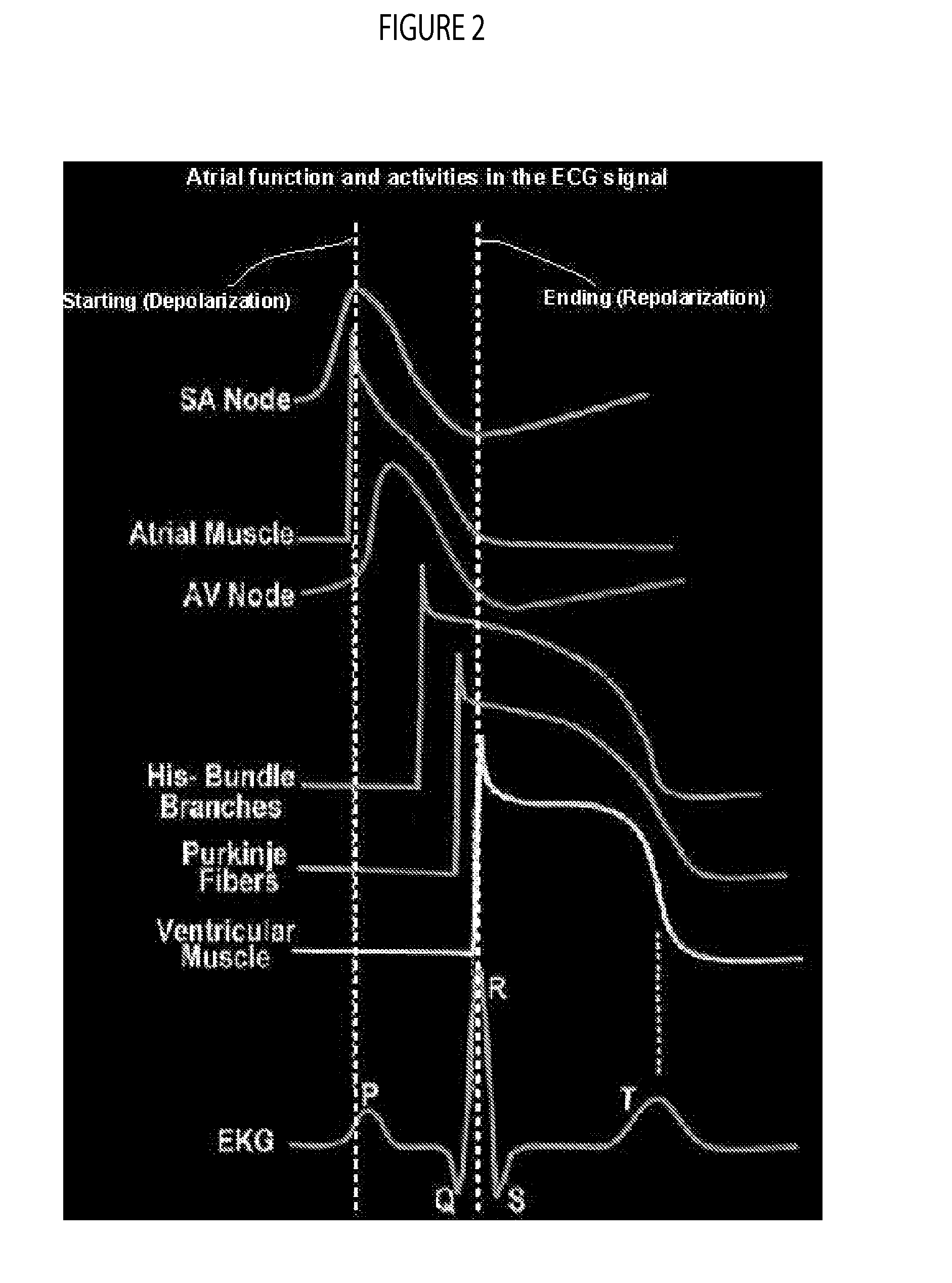 Signal Analysis System for Heart Condition Determination