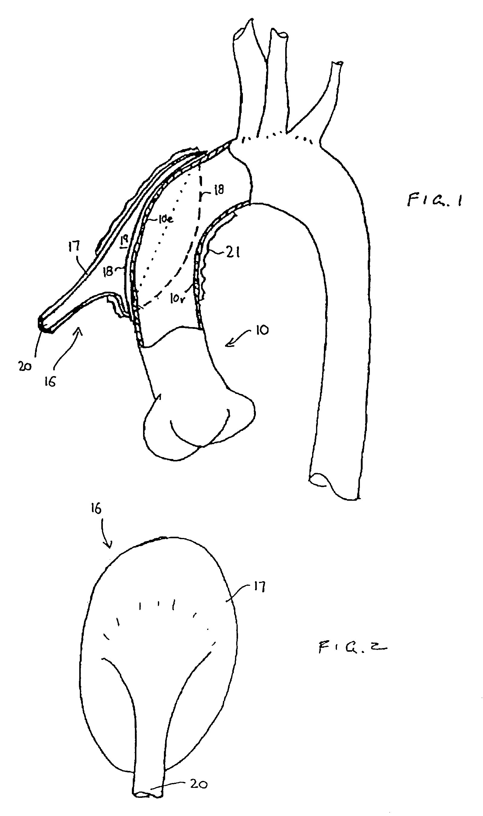 Heart assist device utilising aortic deformation