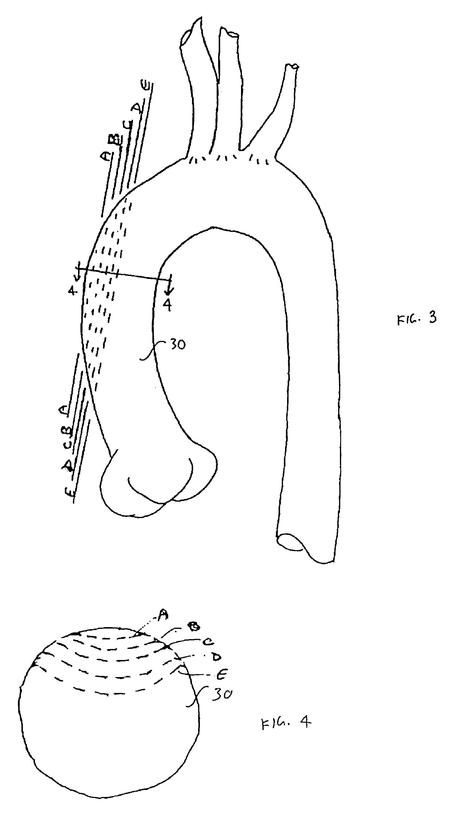 Heart assist device utilising aortic deformation