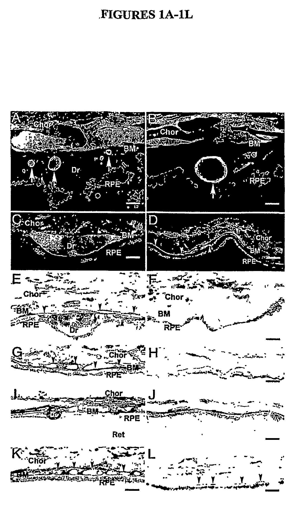 Methods and reagents for treatment and diagnosis of age-related macular degeneration