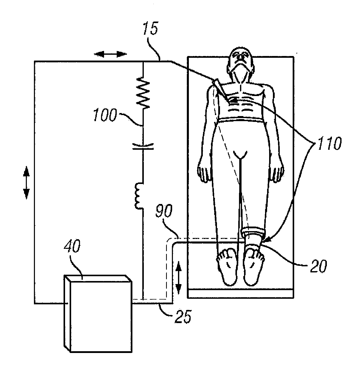 Connection of a bipolar electrosurgical hand piece to a monopolar output of an electrosurgical generator