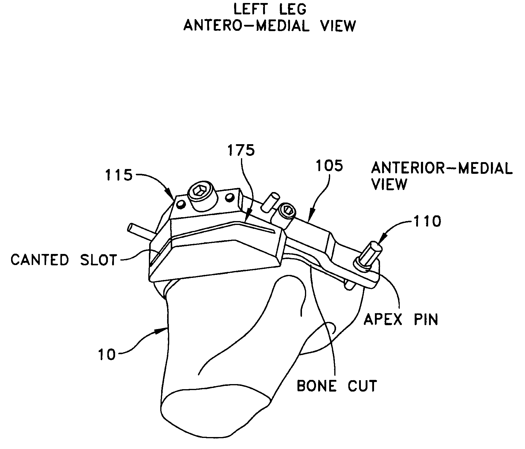 Method and apparatus for forming a wedge-like opening in a bone for an open wedge osteotomy