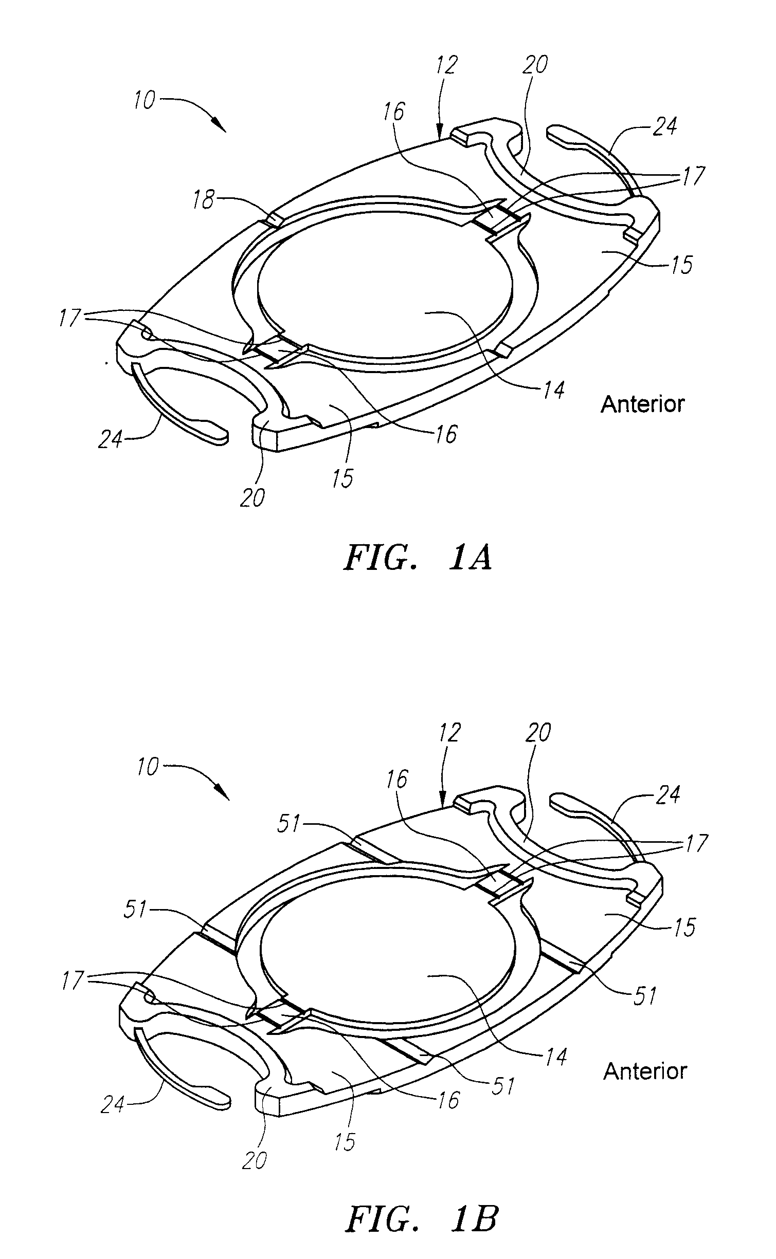 "W" Accommodating Intraocular Lens