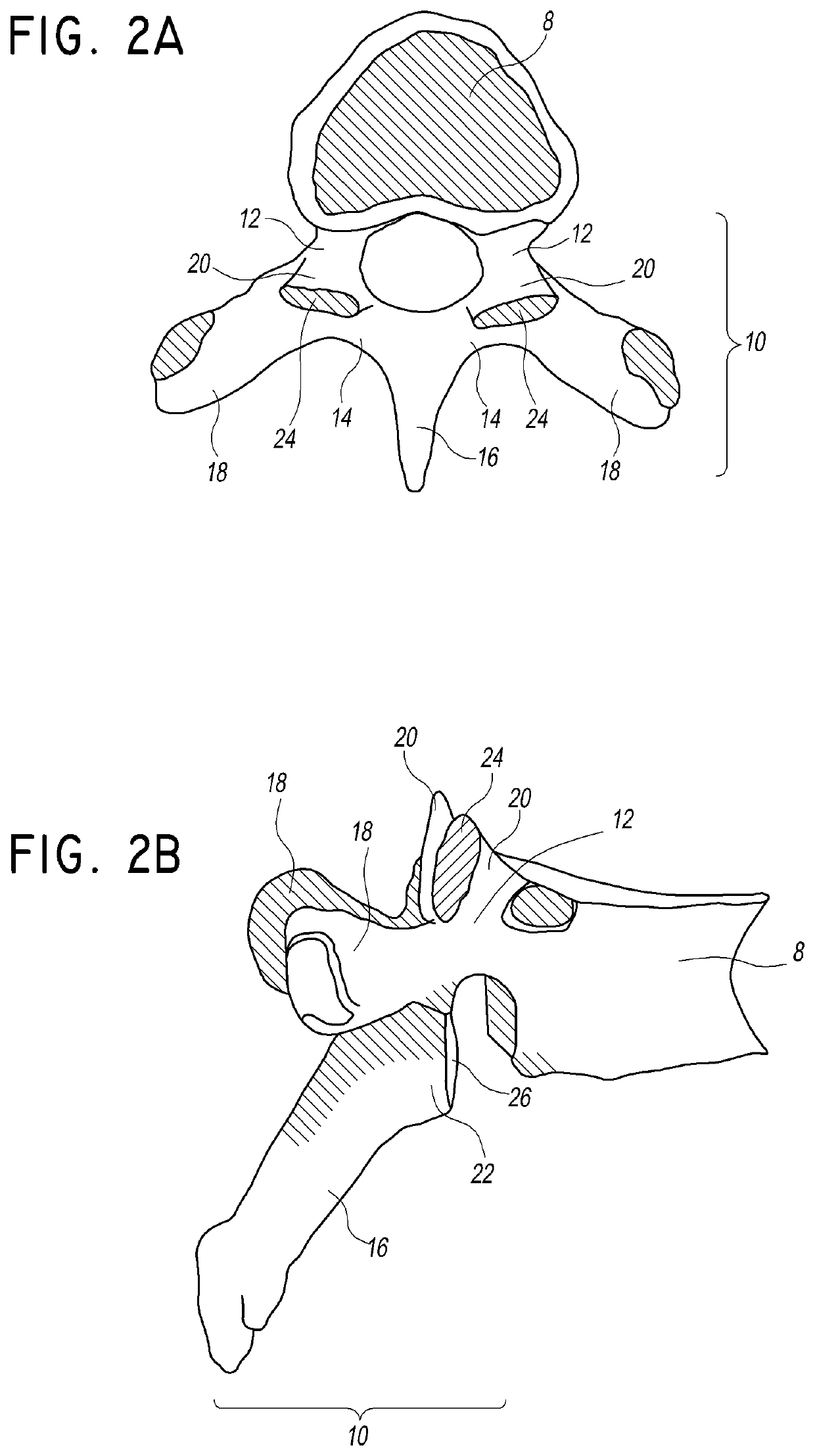 Facet joint implant