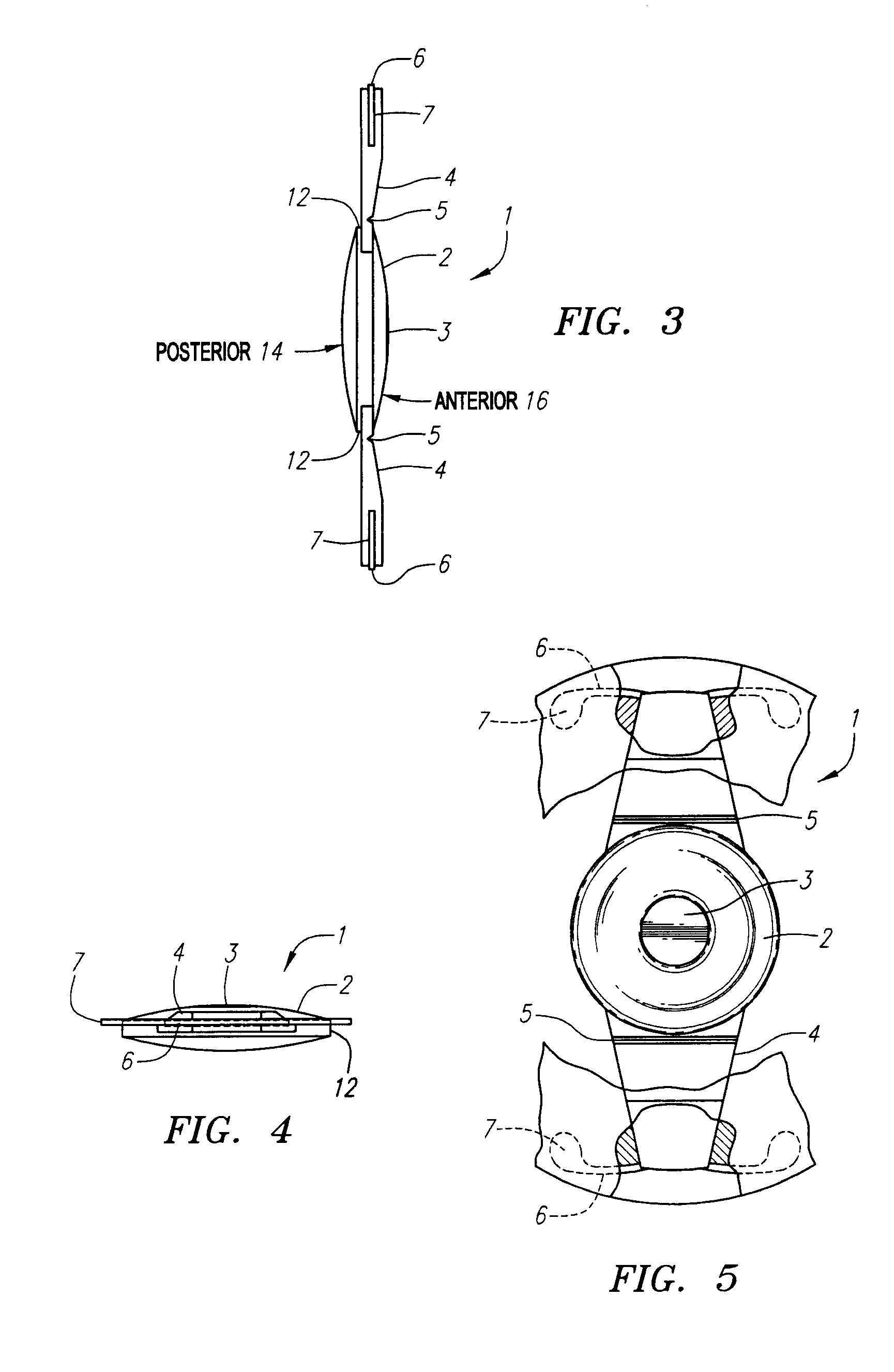 Accommodative Intraocular Lens