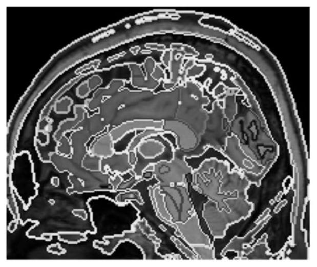 Brain image processing method, electronic equipment and computer readable storage medium