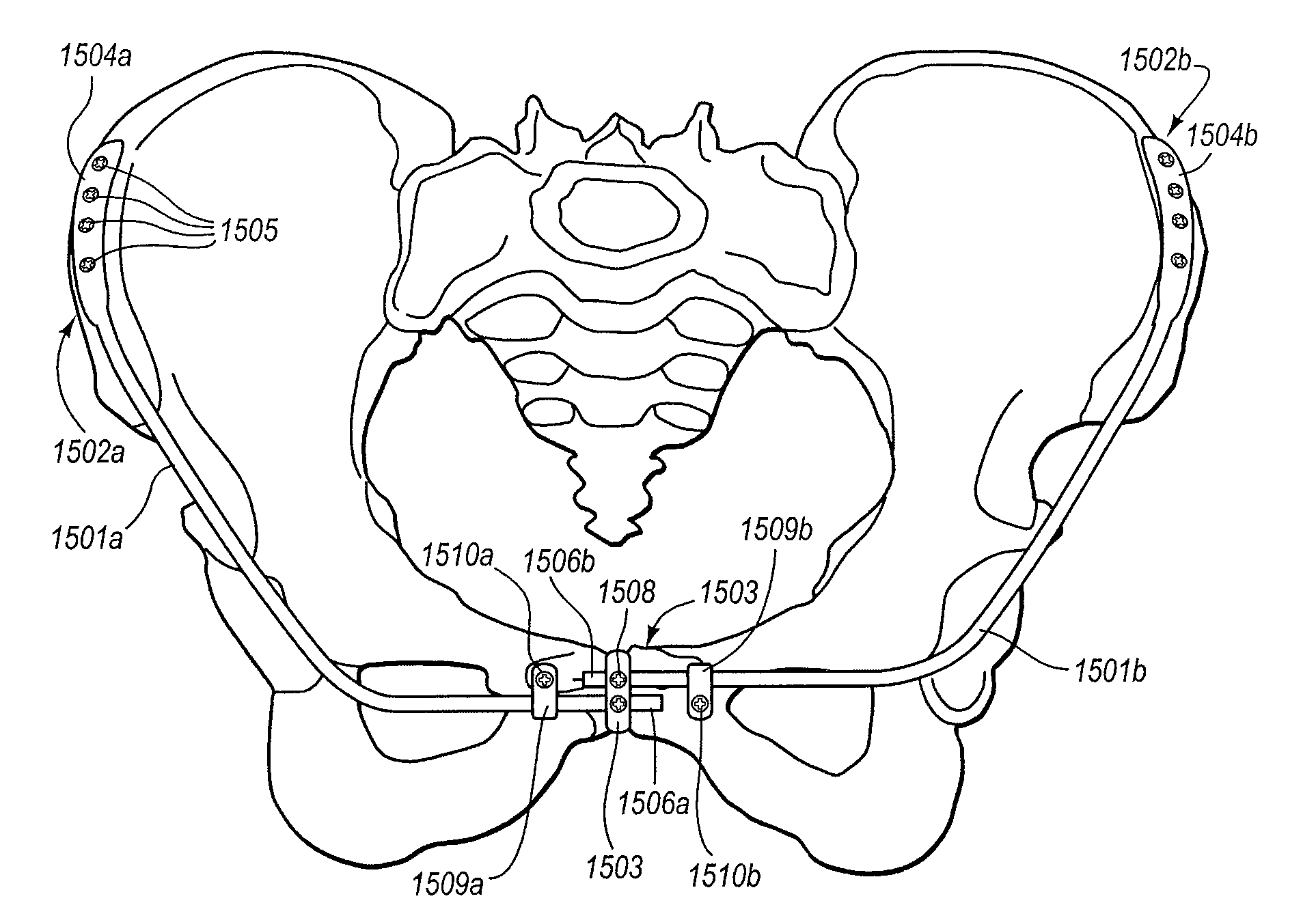 Device and method for less invasive surgical stabilization of pelvic fractures