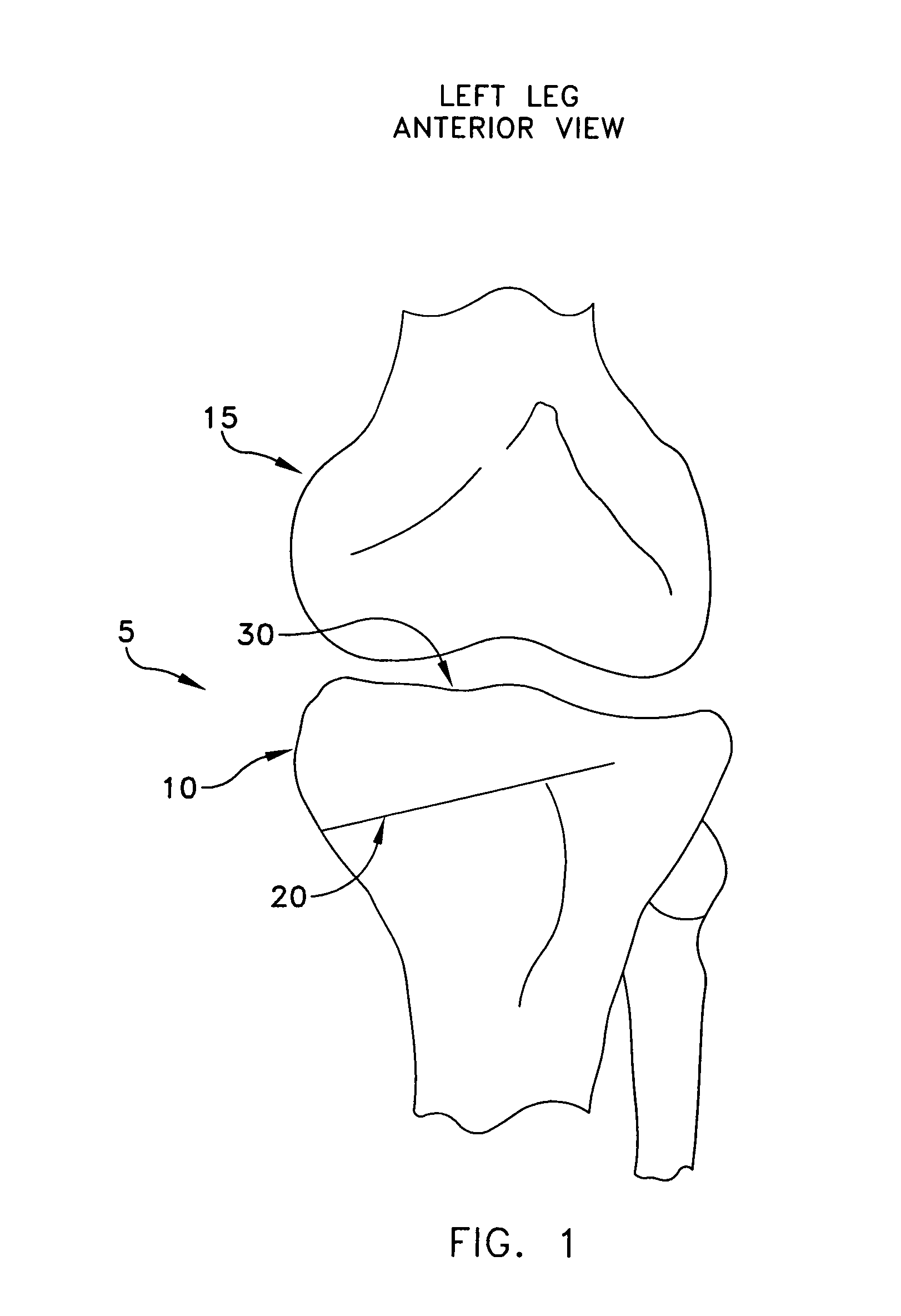 Method and apparatus for performing an open wedge, high tibial osteotomy