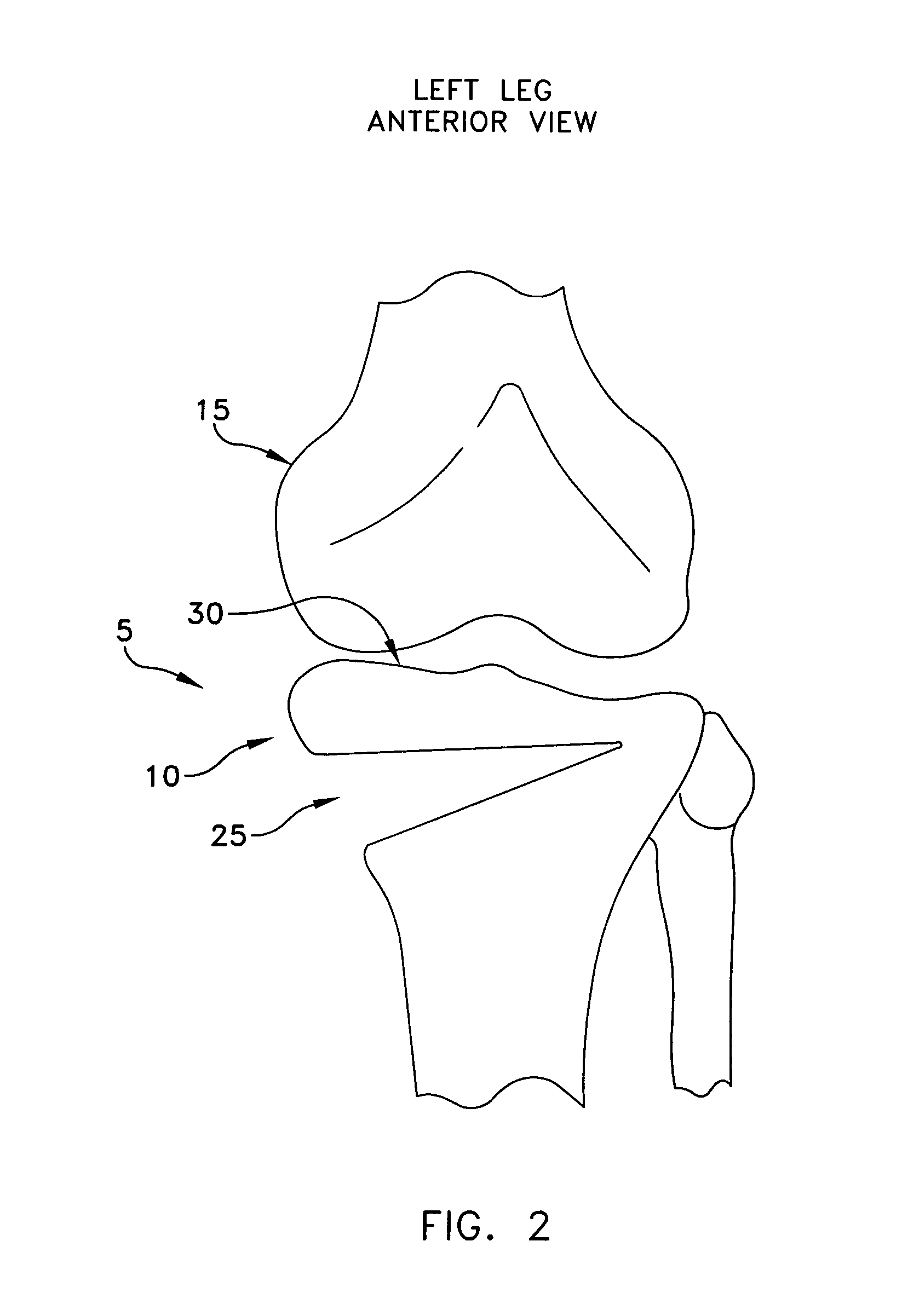 Method and apparatus for performing an open wedge, high tibial osteotomy