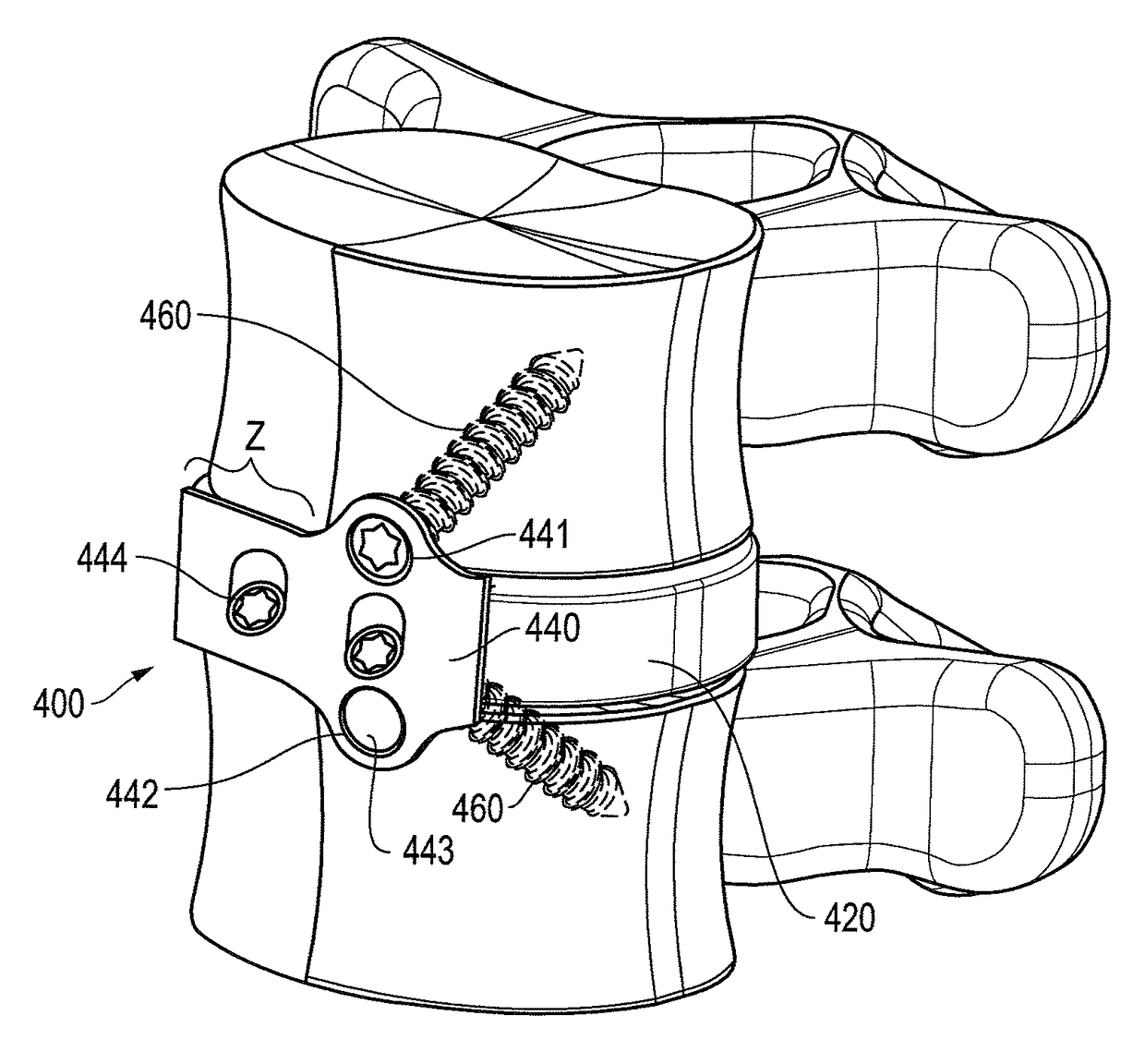 Interbody fusion device with lipped anterior plate and associated methods