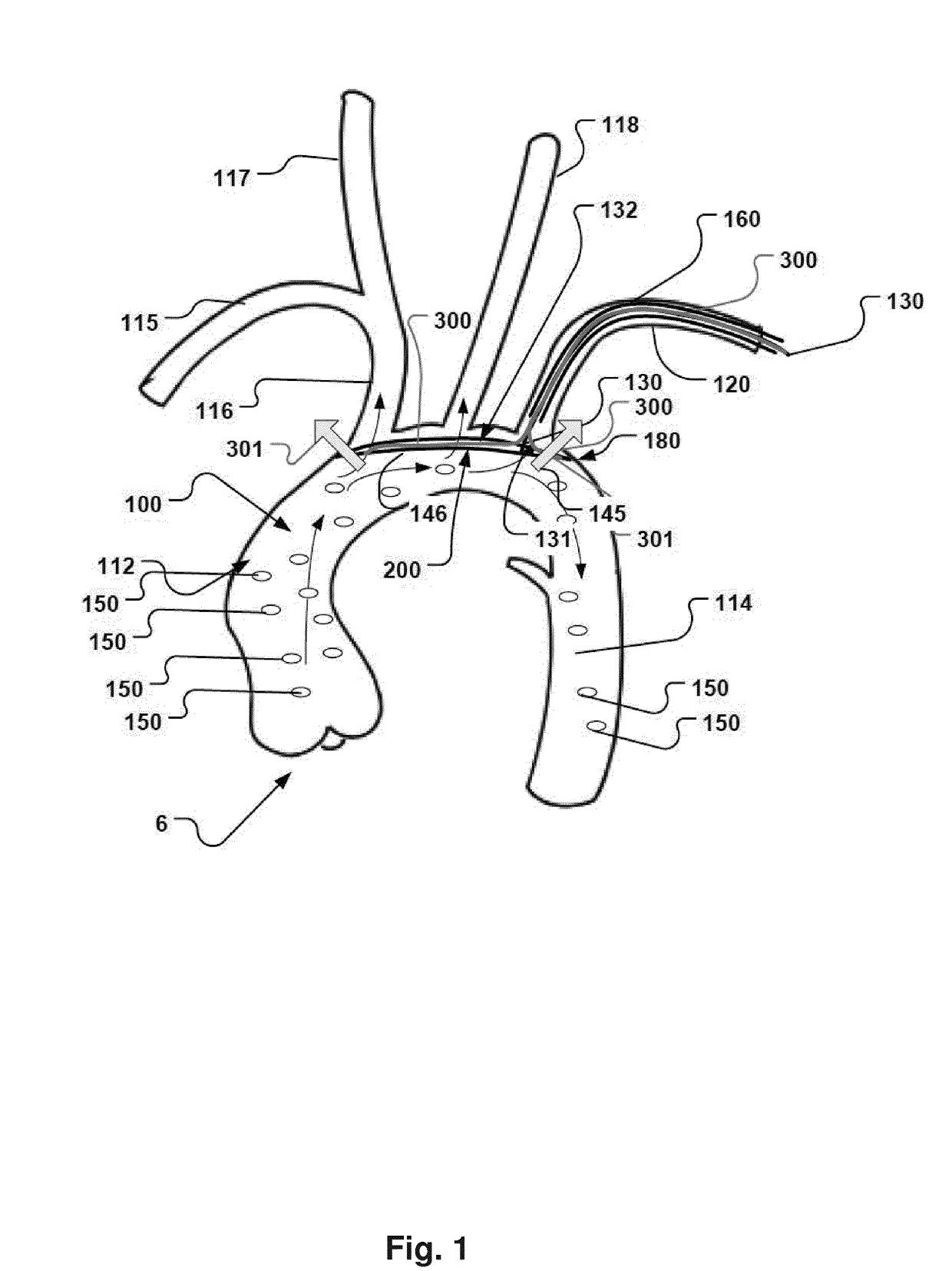 Improved embolic protection device and method