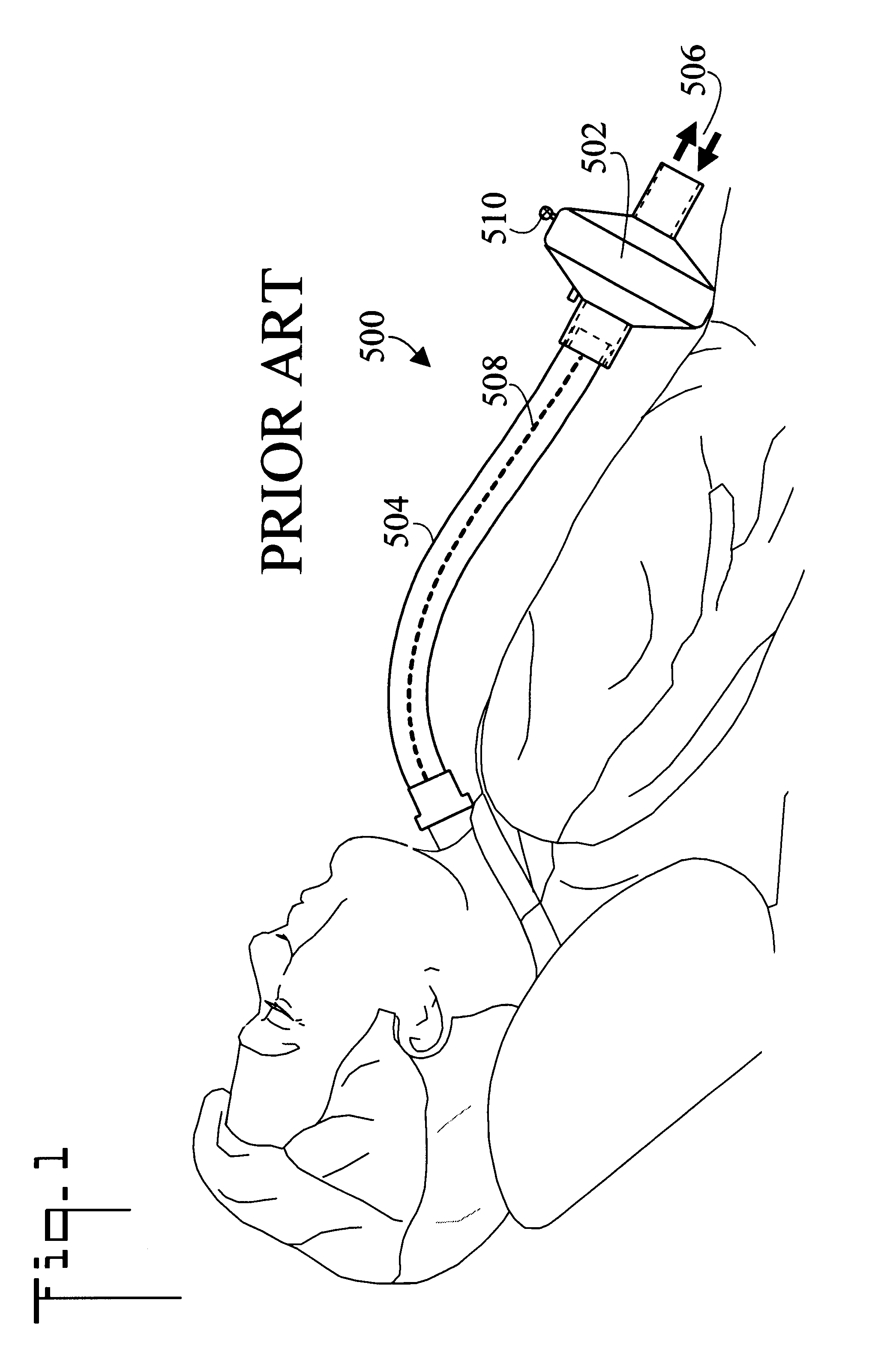 Method of breathing tracheally