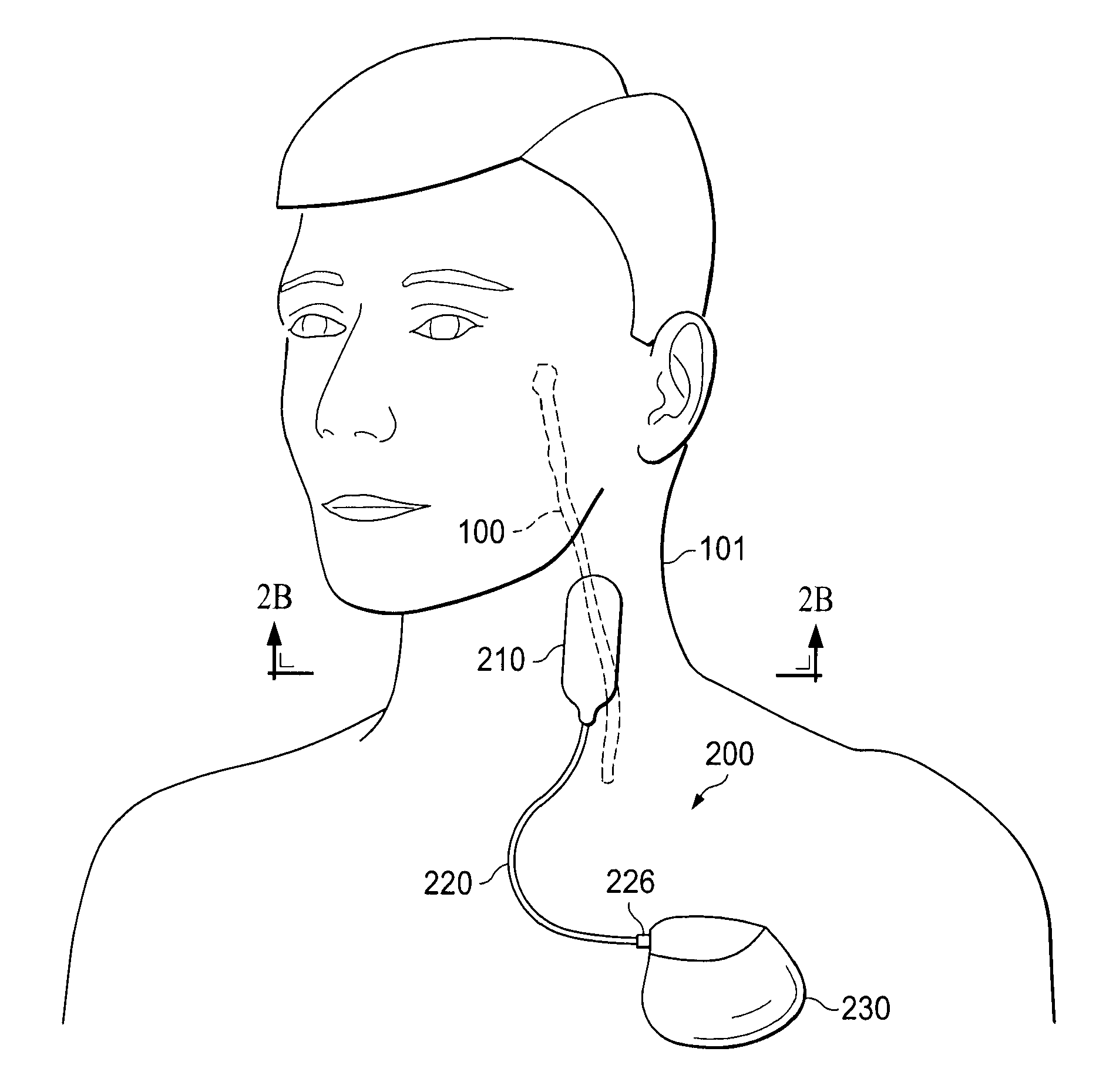 Devices and Methods for Screening of Vagal Nerve Stimulation