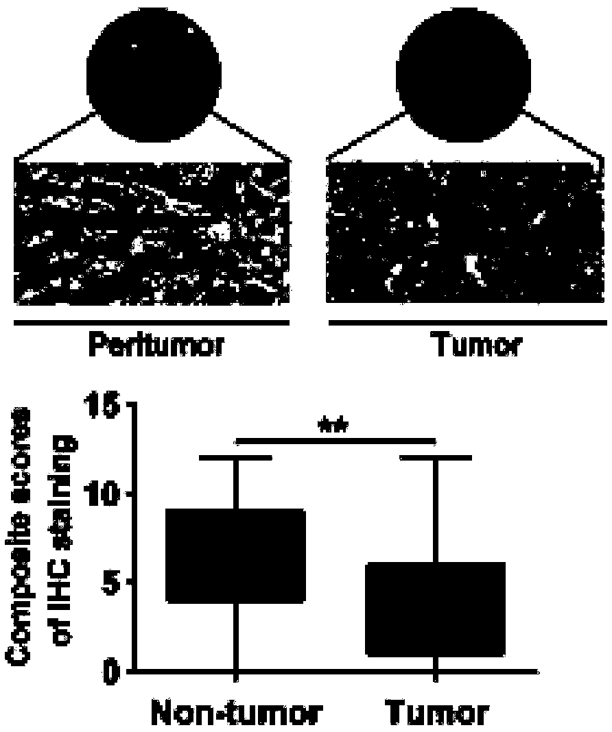 Application of pattern recognition receptor TREM2 in liver cancer prognosis and treatment