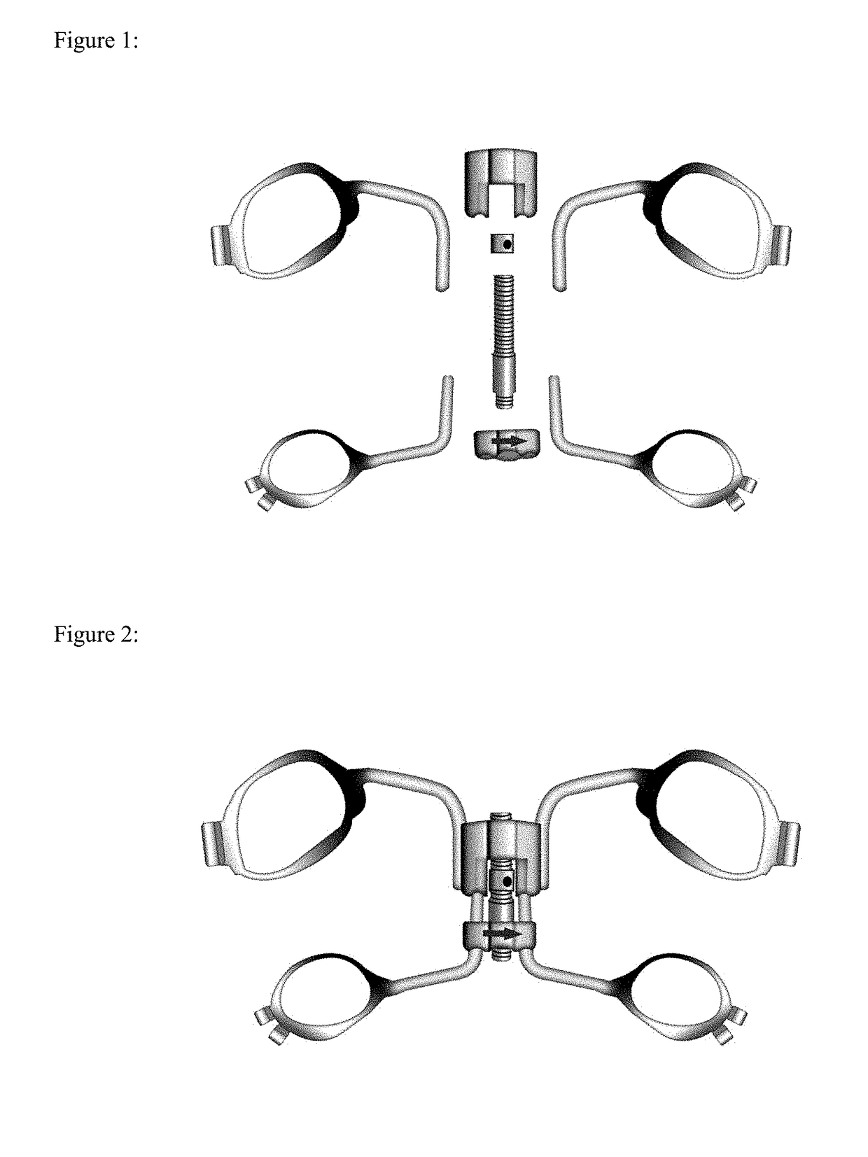 Method and system for treatment of maxillary deficiency using Hyrax