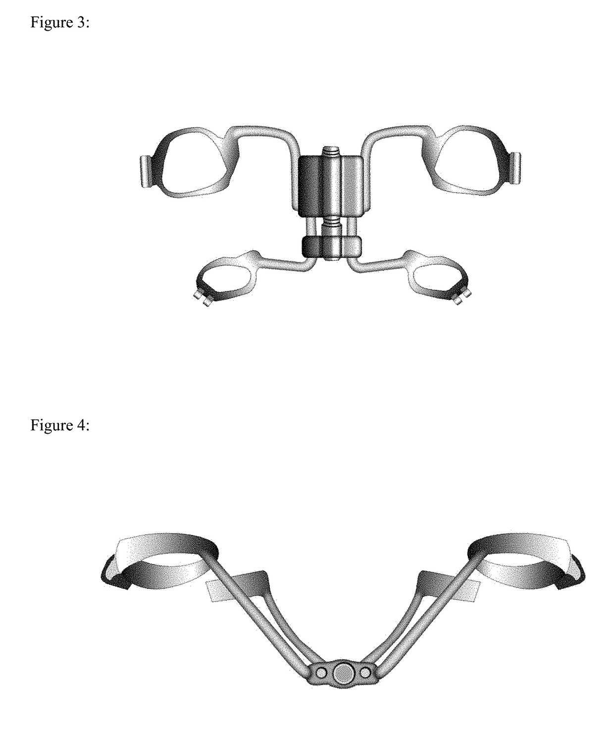 Method and system for treatment of maxillary deficiency using Hyrax