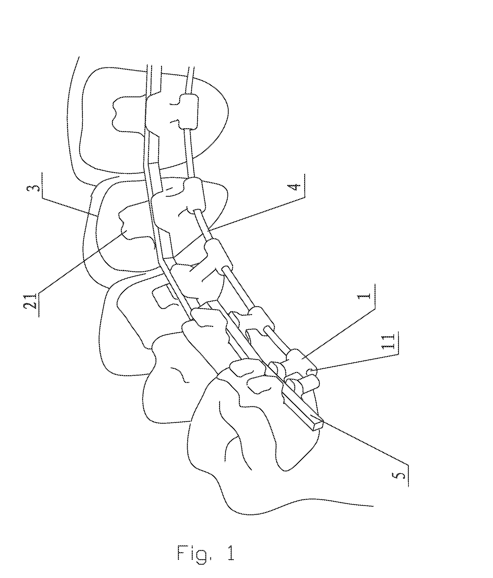 Personalized Orthodontic Appliance Having Orthoaxis Function