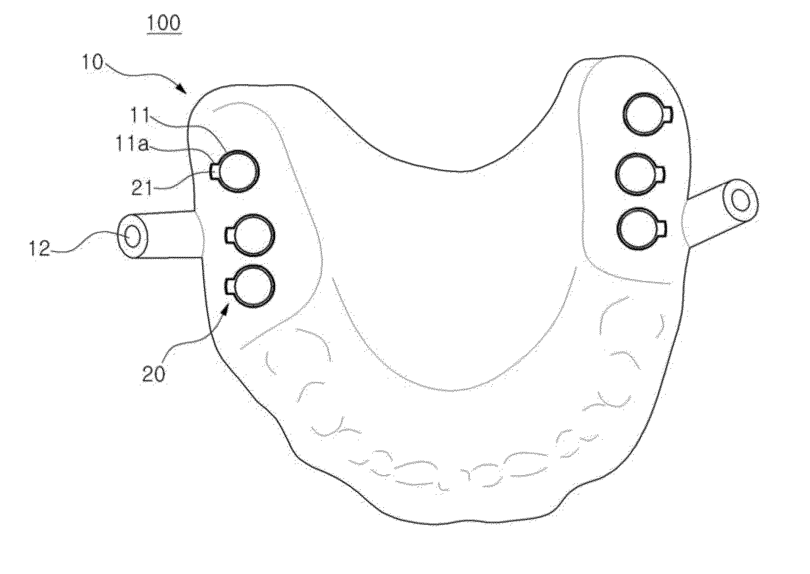 Dental implant insertion set and manufacturing method thereof