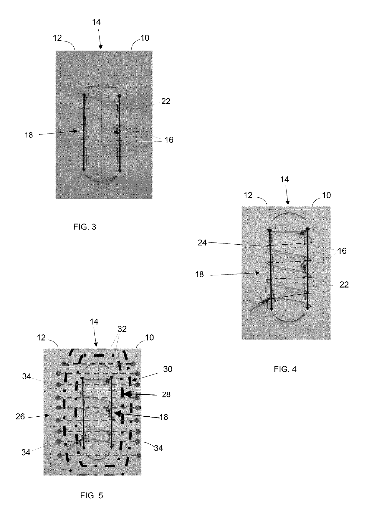 Sutures and suturing techniques