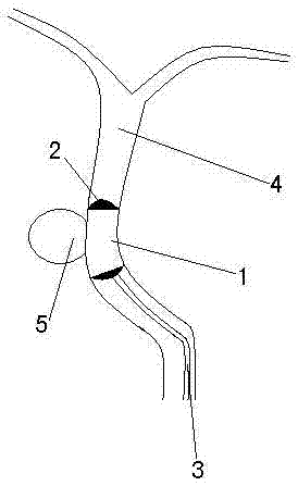 A kind of vascular graft that can be/directly pasted