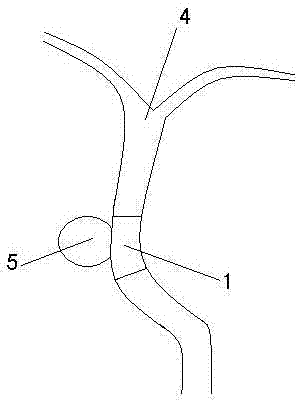 A kind of vascular graft that can be/directly pasted