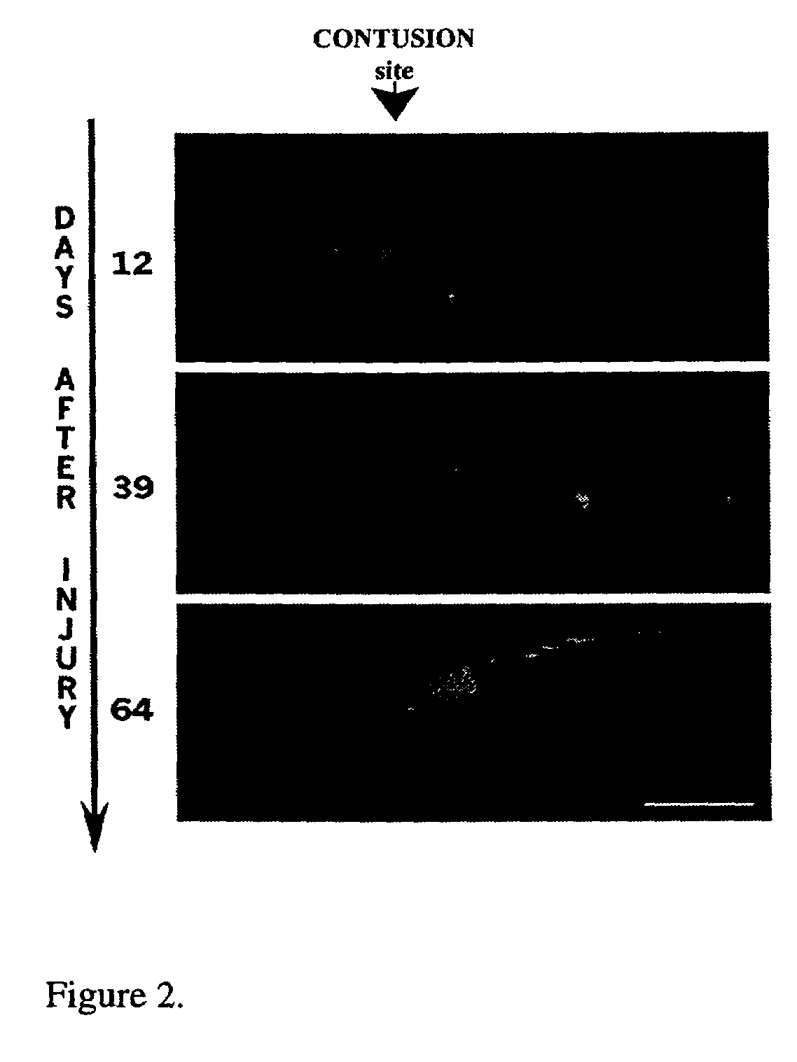 Beta interferon for the treatment of chronic spinal cord injury