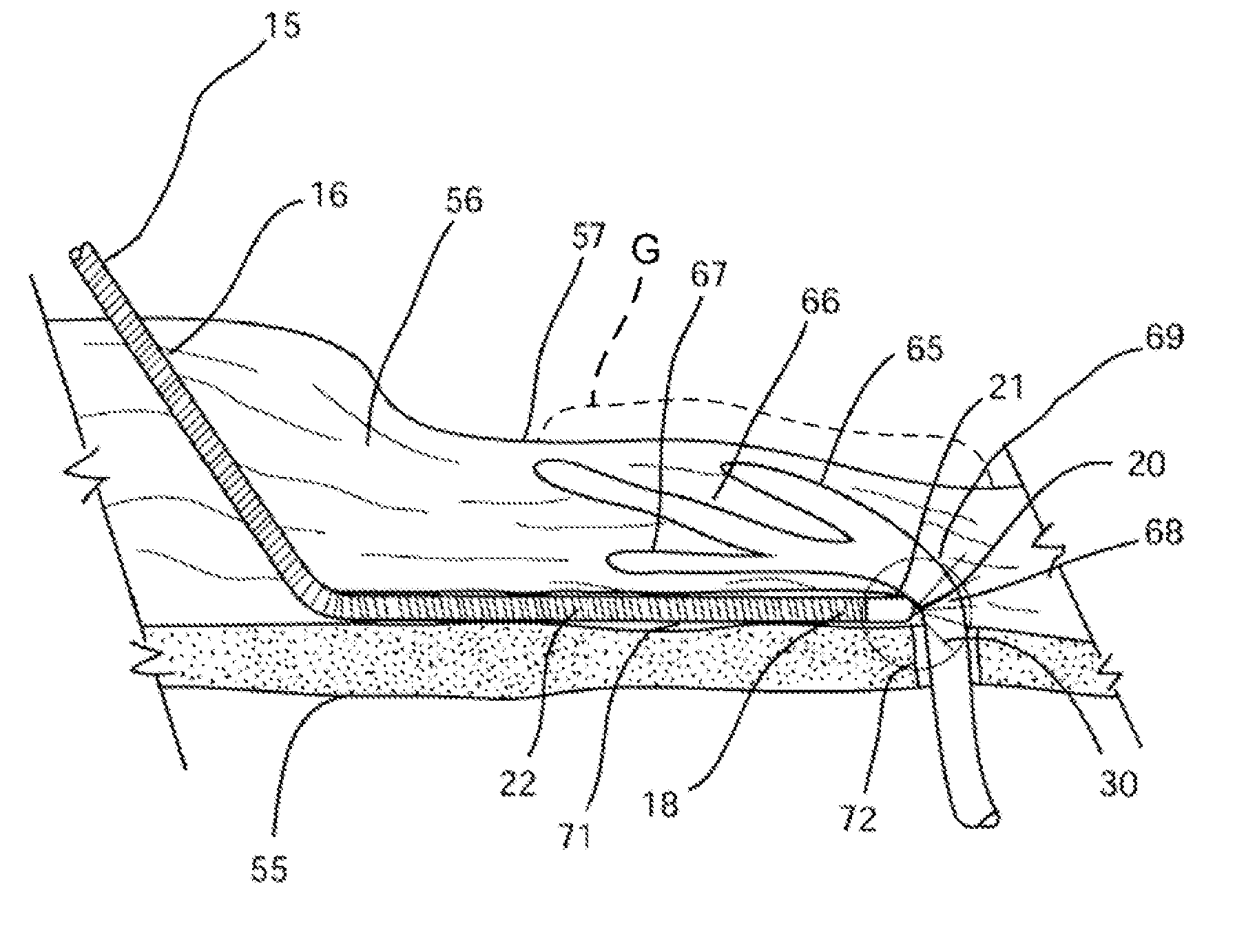 Apparatus and method for treating rhinitis