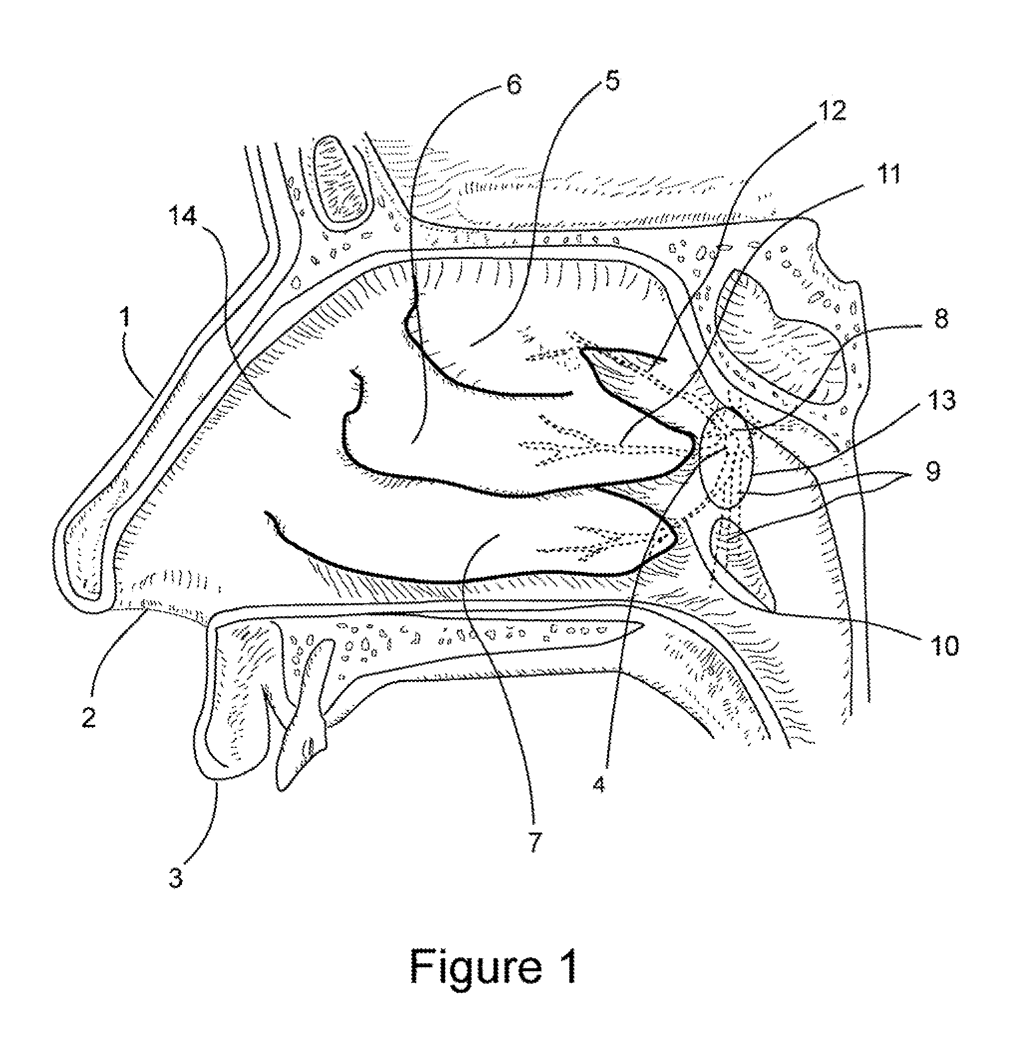 Apparatus and method for treating rhinitis