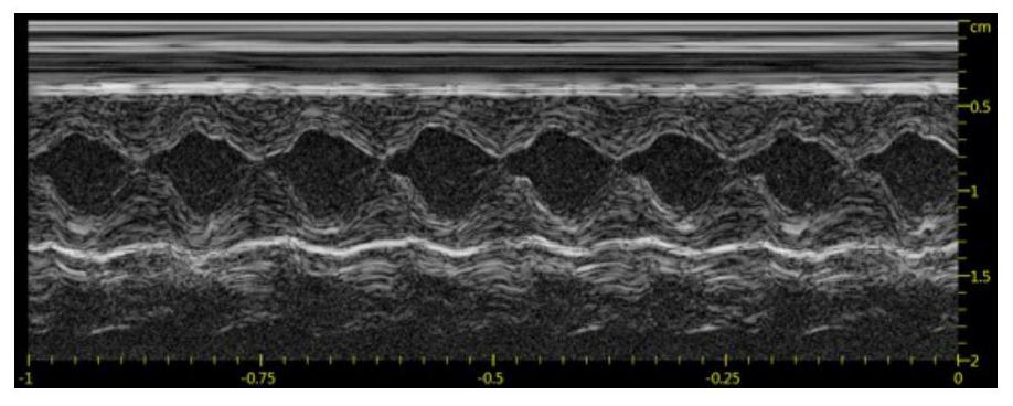 Application of a combined preparation of mesenchymal stem cell and exosome in preparation of myocardial infarction drug