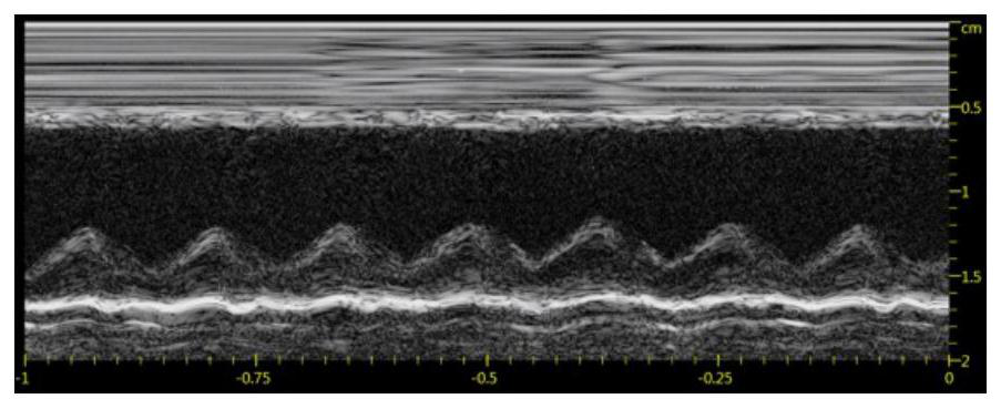 Application of a combined preparation of mesenchymal stem cell and exosome in preparation of myocardial infarction drug