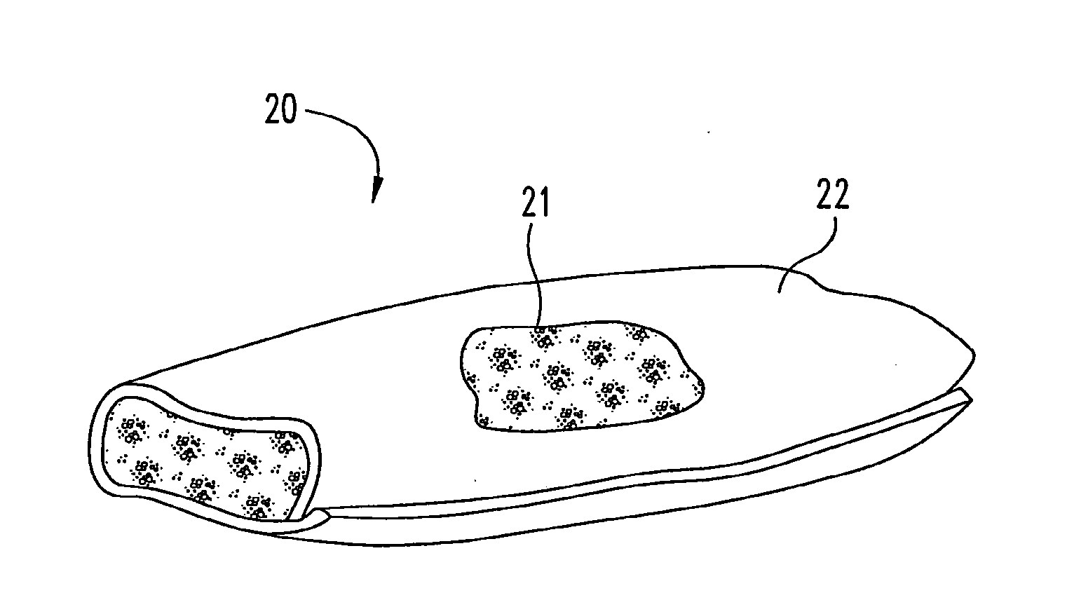 Osteogenic Implants with Combined Implant Materials and Methods for Same