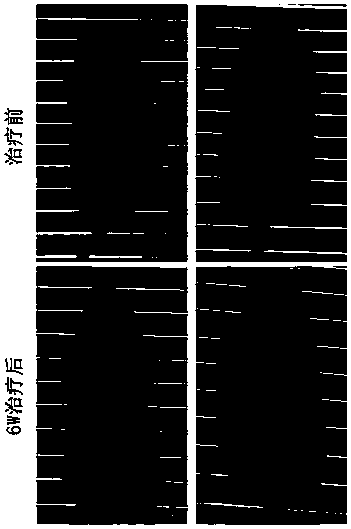 Application of mesenchymal stem cell exosome preparation in treating alopecia areata