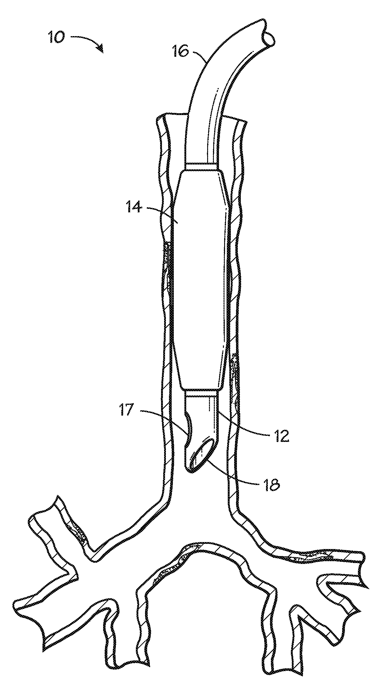 Self-sizing adjustable endotracheal tube