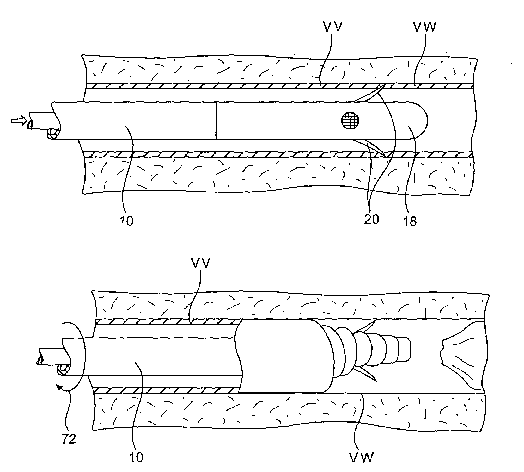 Method and apparatus for avulsion of varicose veins