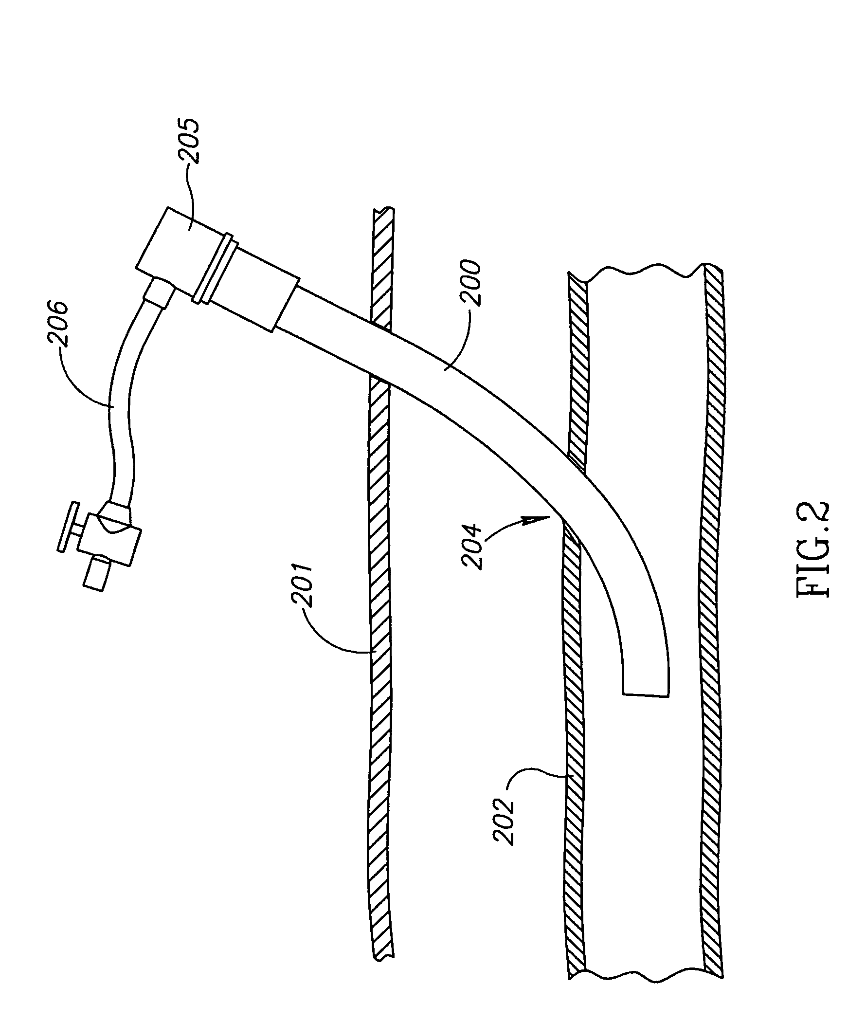 Biodegradable Closure Device