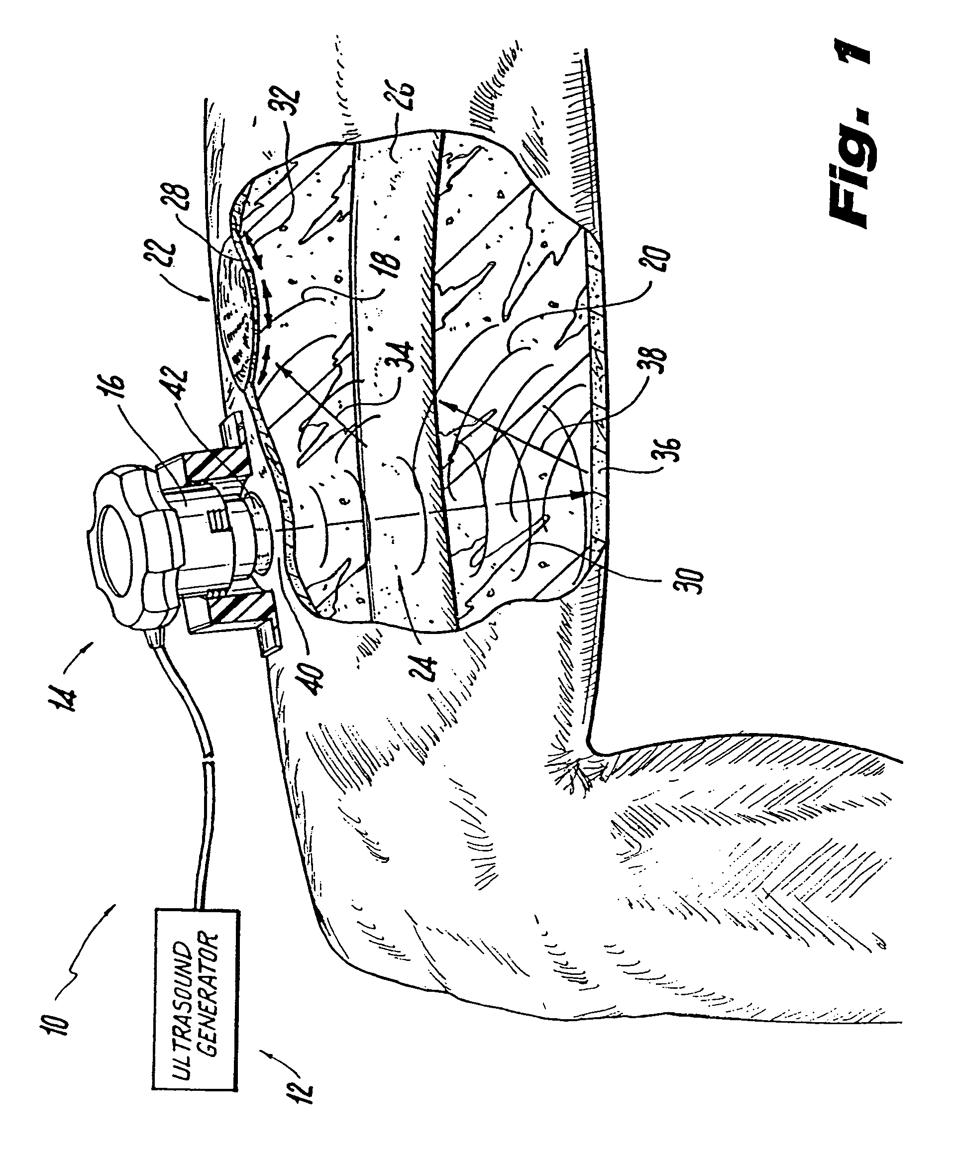 Ultrasonic treatment for wounds