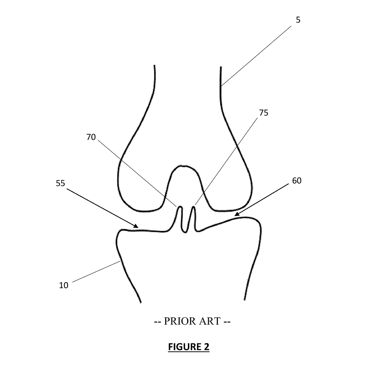 Total knee arthroplasty system and method