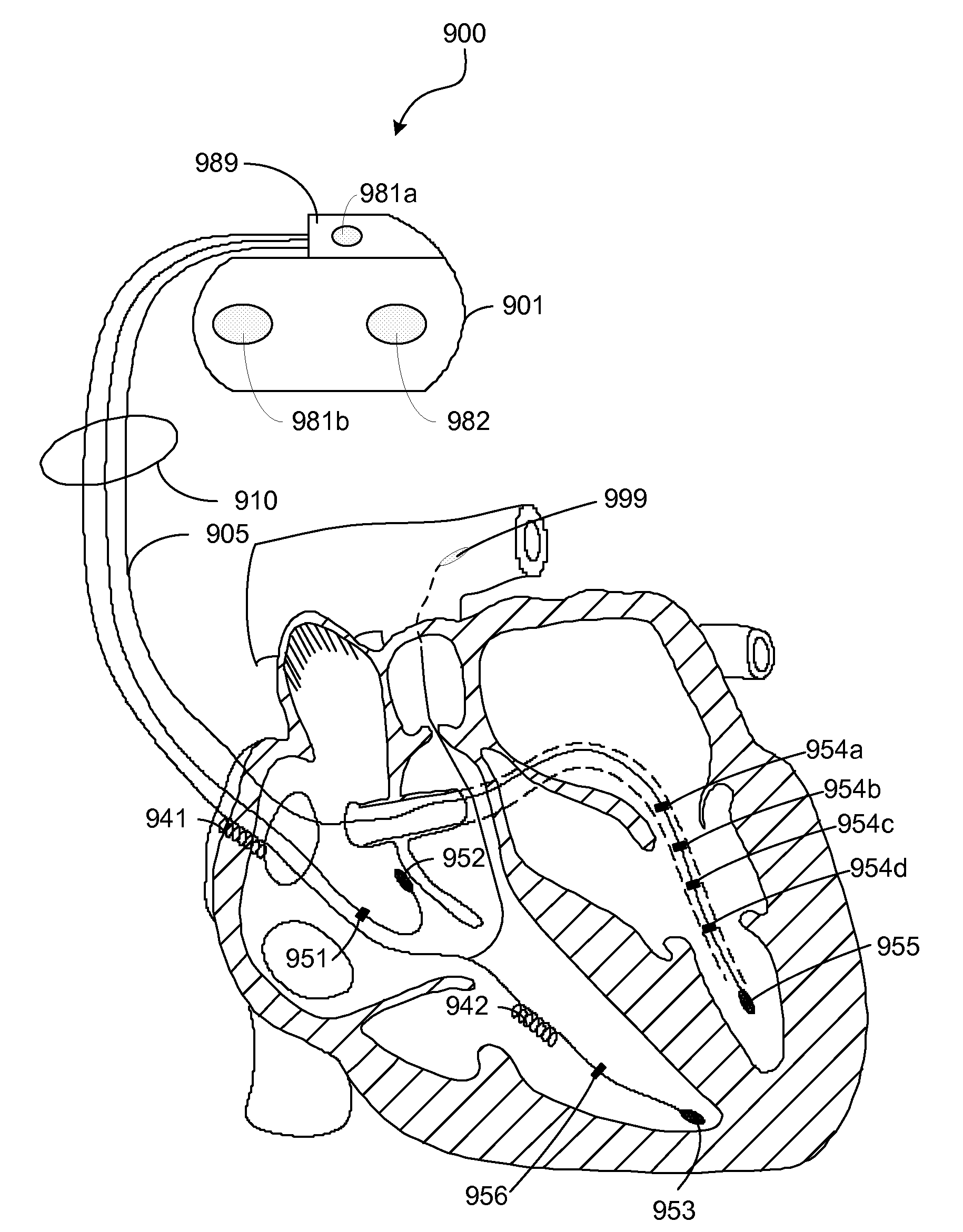 Monitoring Right Ventricular Hemodynamic Function During Pacing Optimization