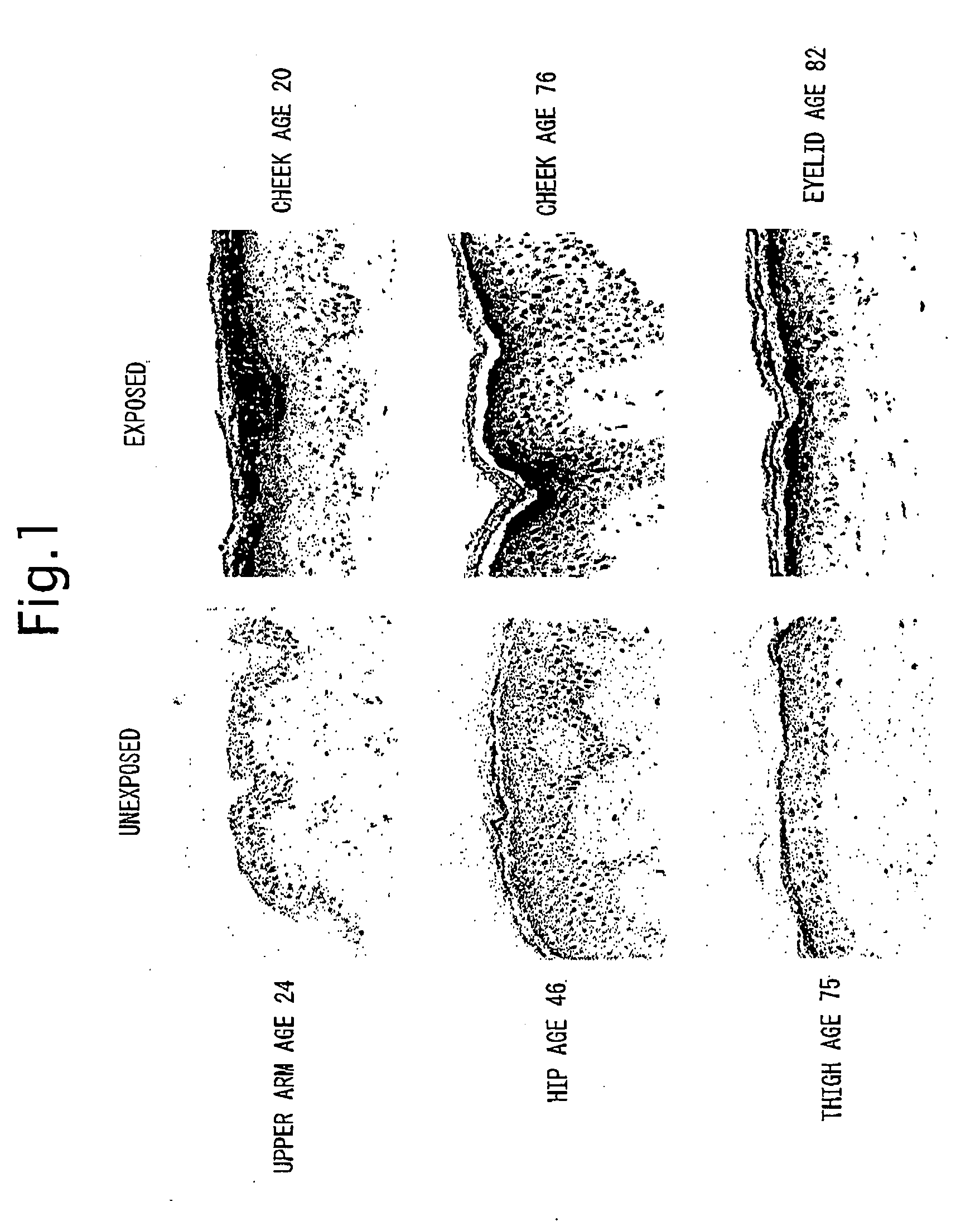 Method and Pharmaceutical Composition for Treating Psoriasis, Squamous Cell Carcinoma and/or Parakeratosis by Inhibiting Expression of Squamous Cell Carcinoma-Related Antigen