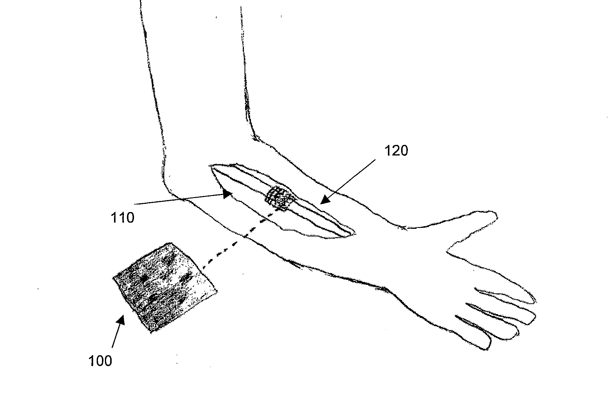 Hemostatic bone graft