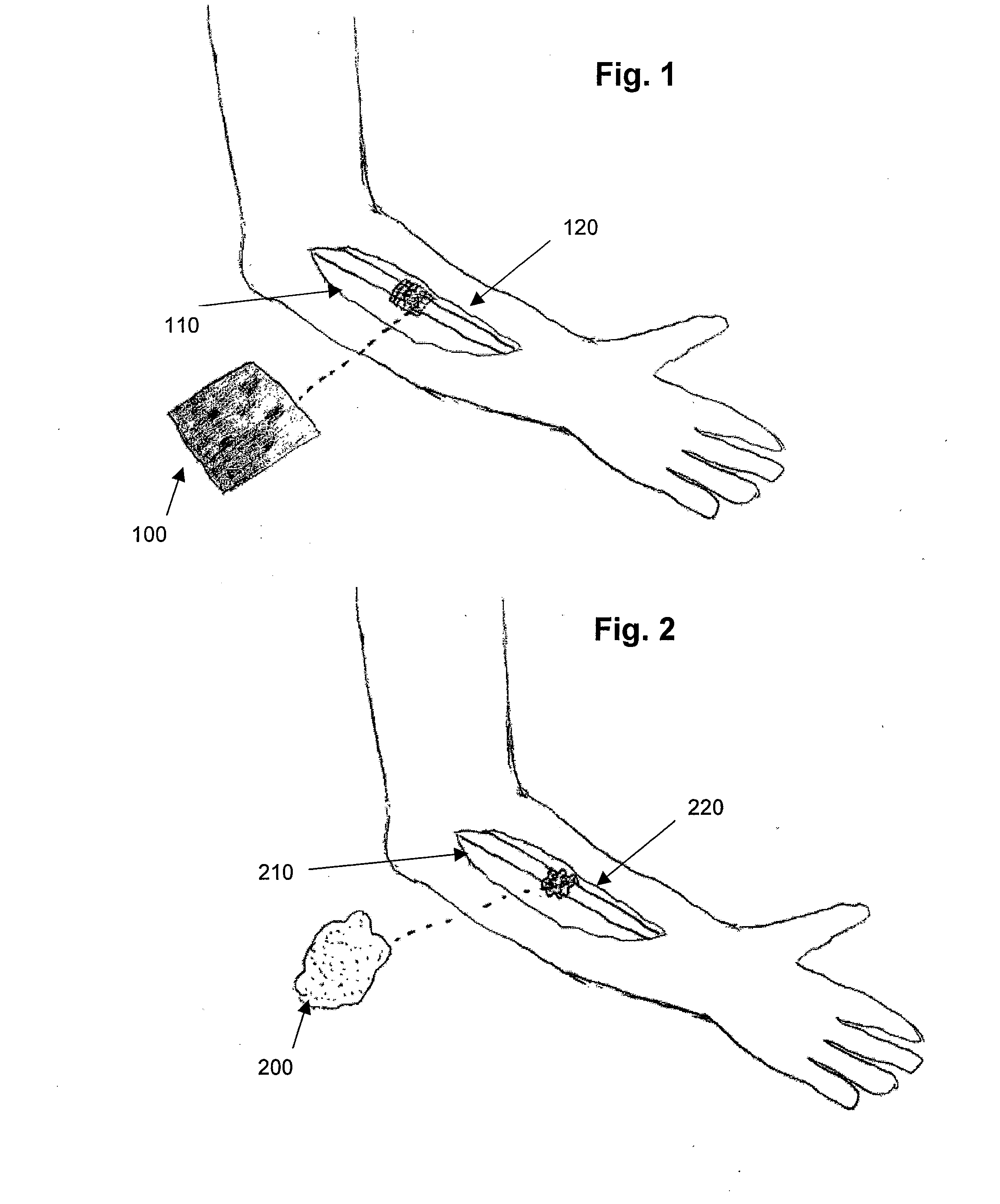 Hemostatic bone graft