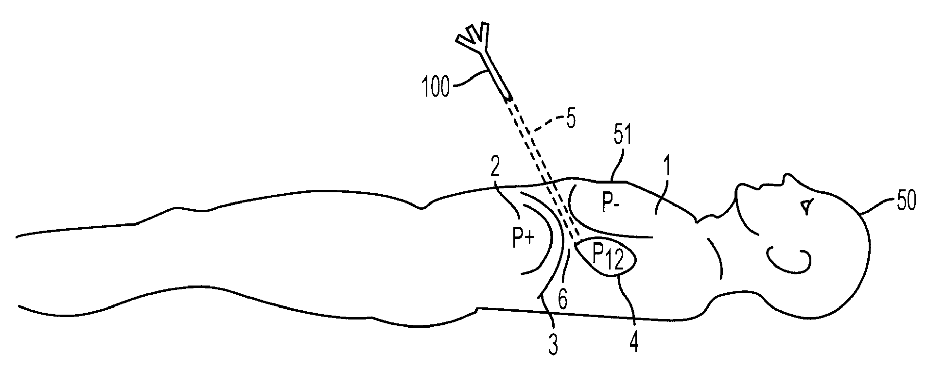 Access Needle Pressure Sensor Device and Method of Use