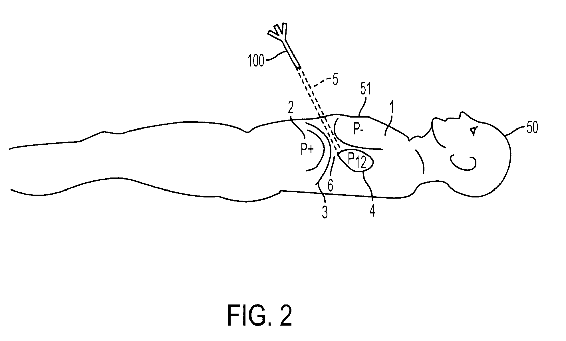 Access Needle Pressure Sensor Device and Method of Use