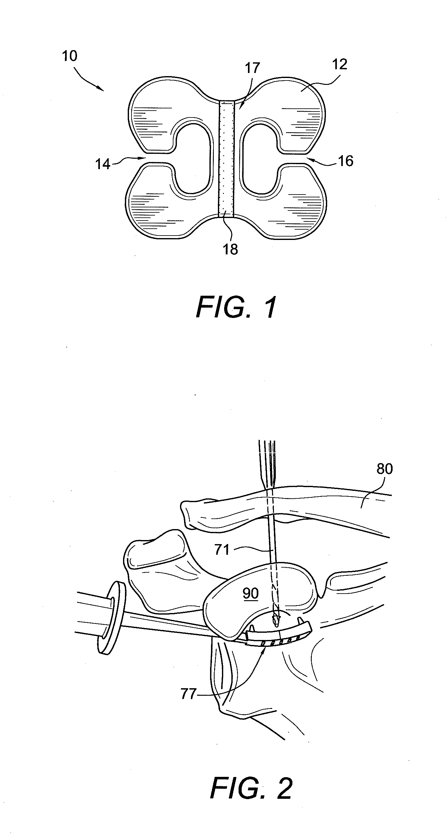 Acromioclavicular joint fixation using suture button contstruct with dog bone-shaped button