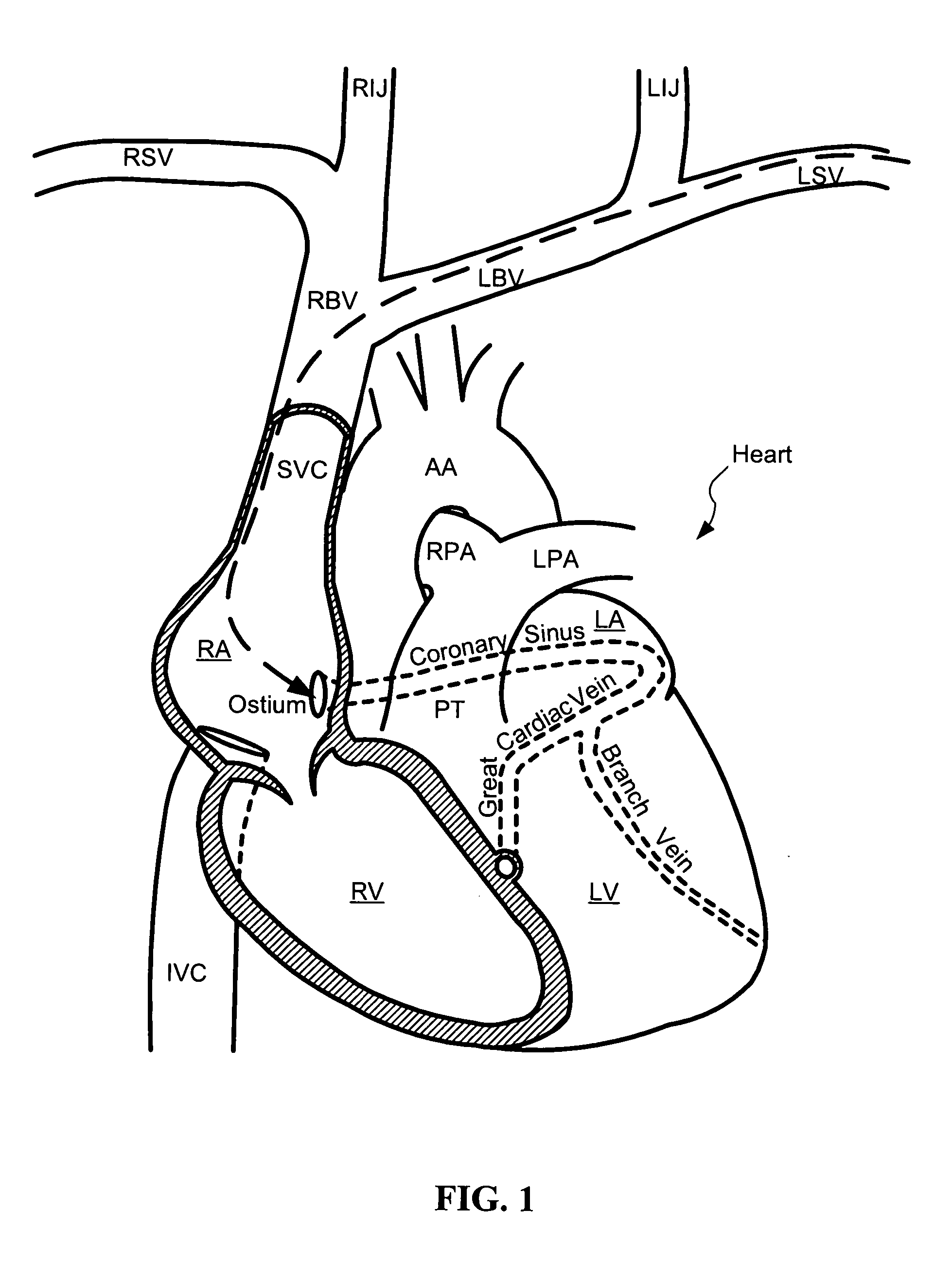 Lead stabilization devices and methods