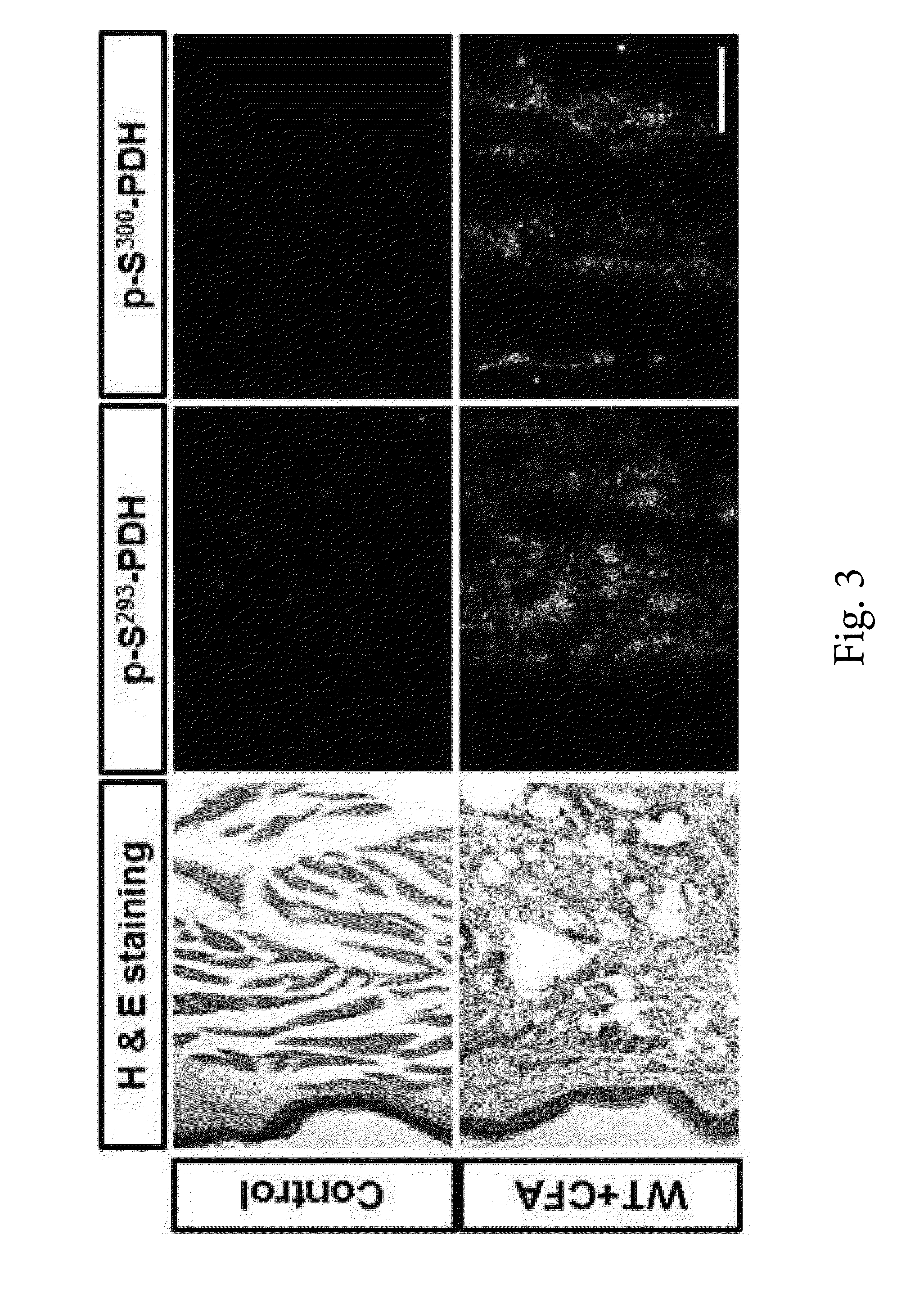 Composition containing pyruvate dehydrogenase kinase inhibitor for treating chronic inflammatory pain