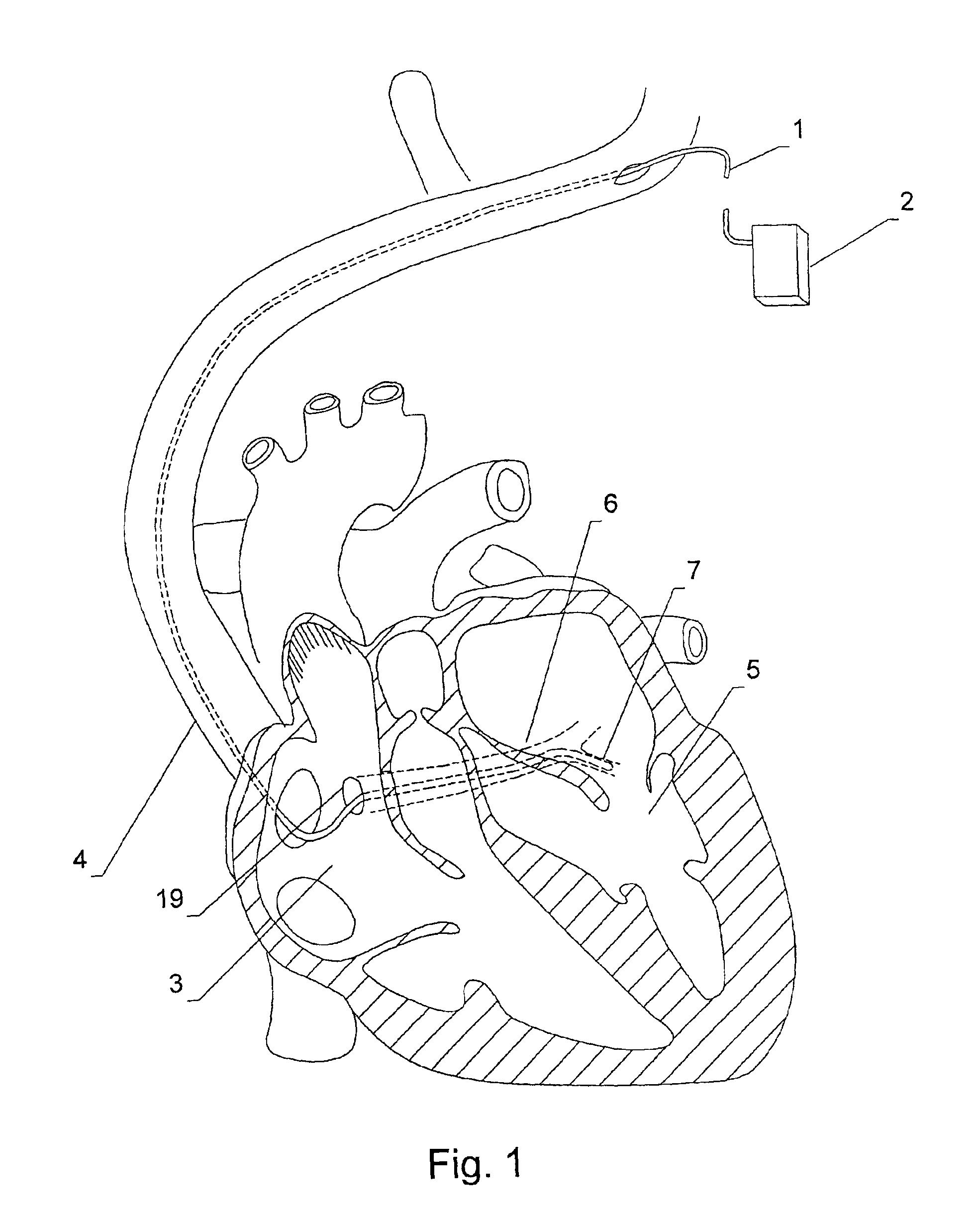 Method and apparatus for monitoring left ventricular work or power